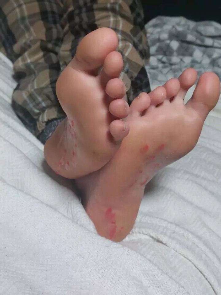 Aftermath of dripping hot candle wax onto my soles ❤️