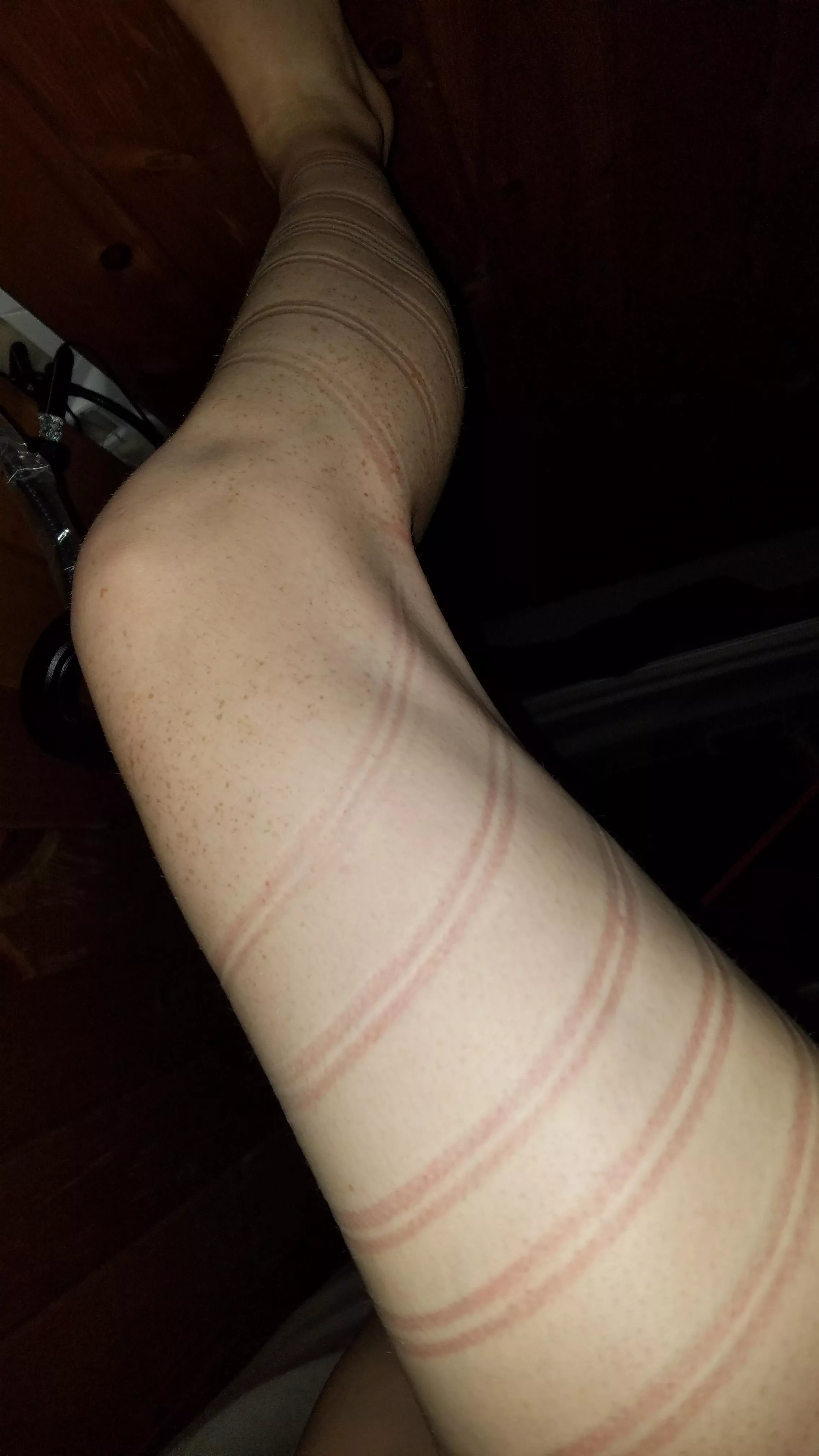 rope marks [f]rom last night