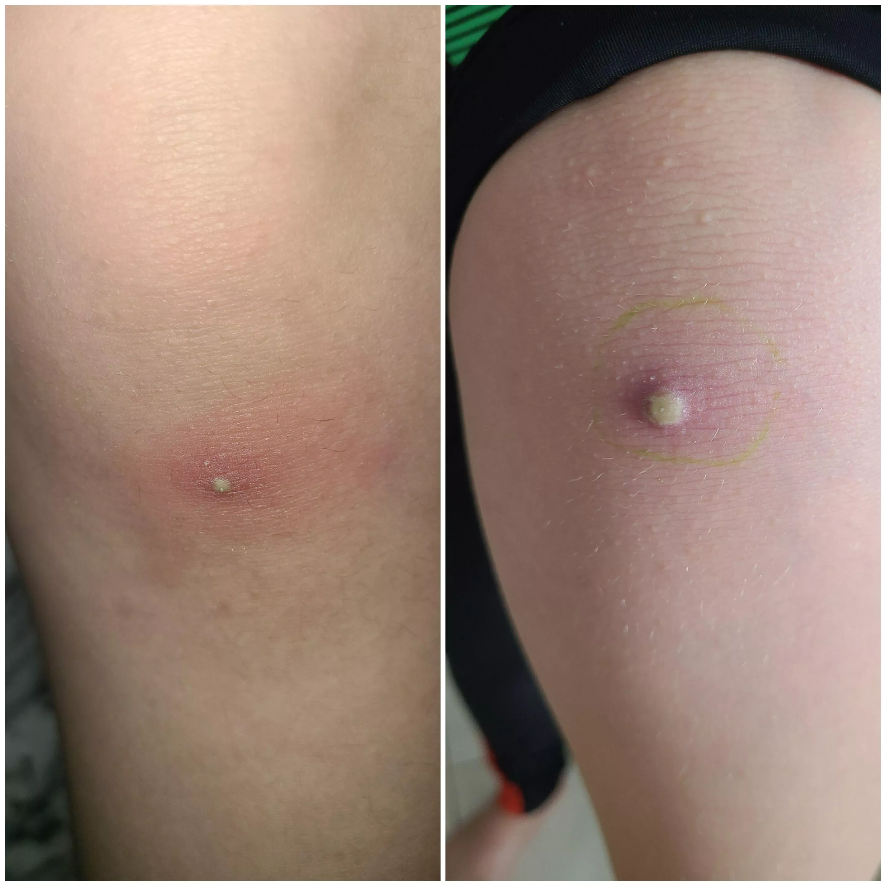 9 year old has this right below the knee.. pics taken 3 days apart. I'm not sure what it could be?! Figured this group might know