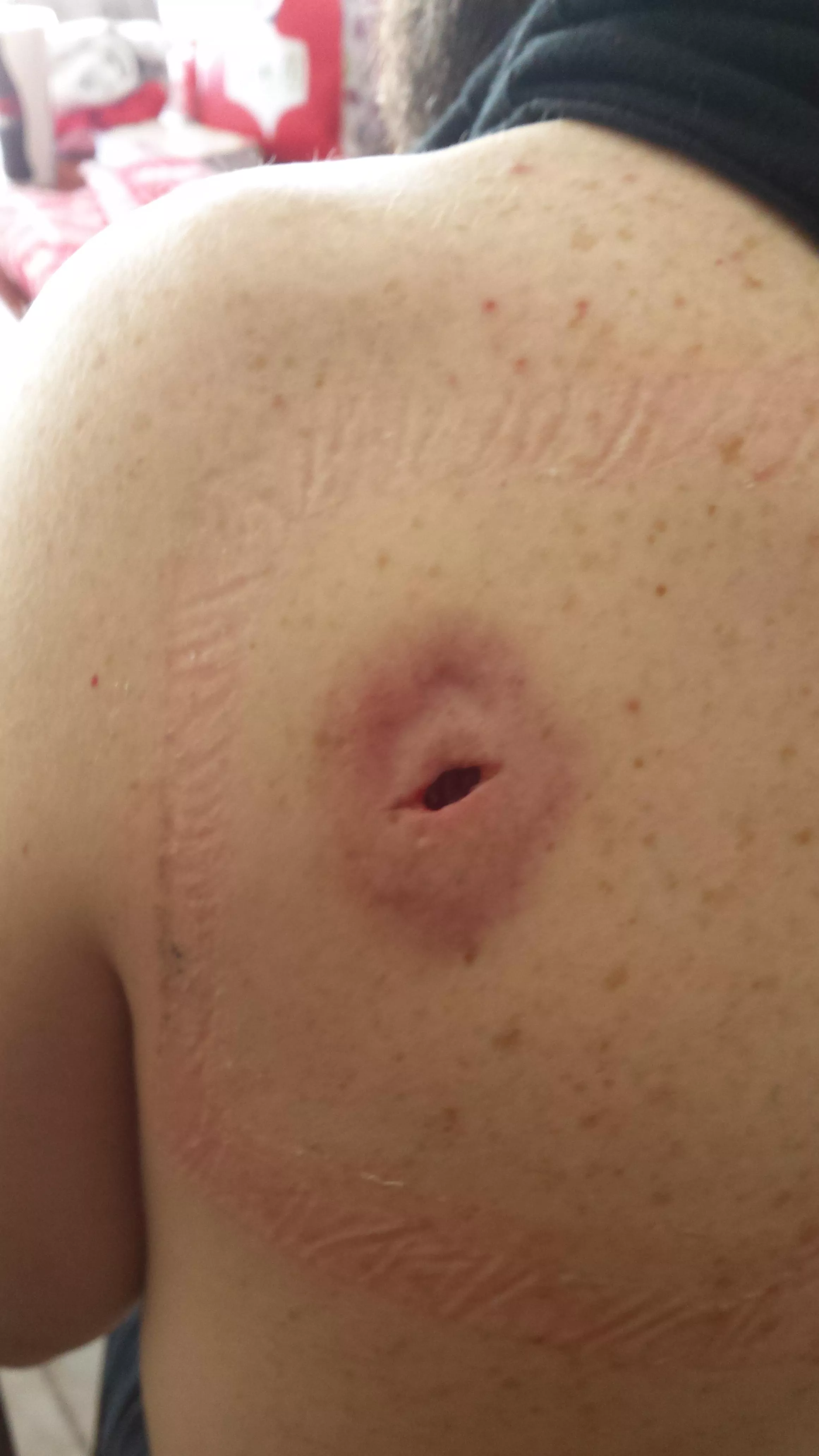 A couple days after the removal of a golf ball size cyst from the shoulder.