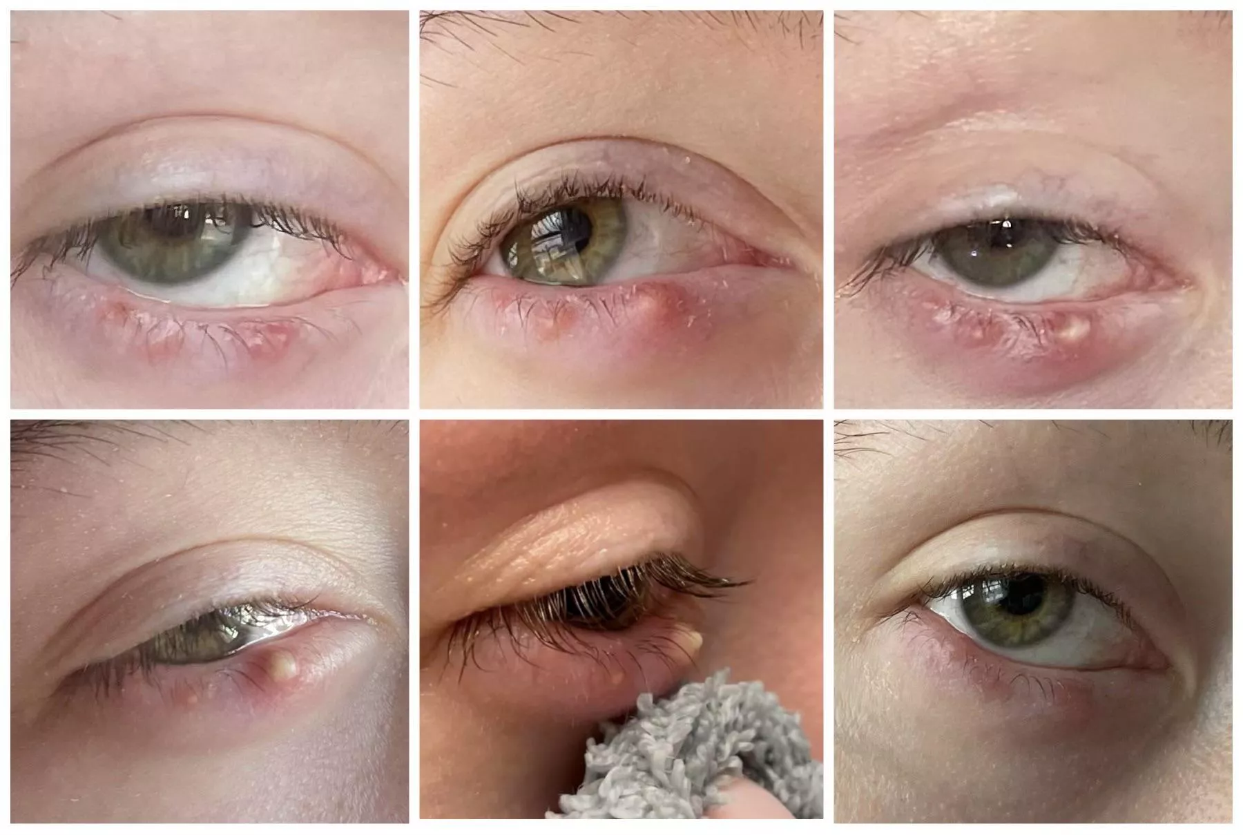 A look back at the progression of the stye I’m still battling a year later.