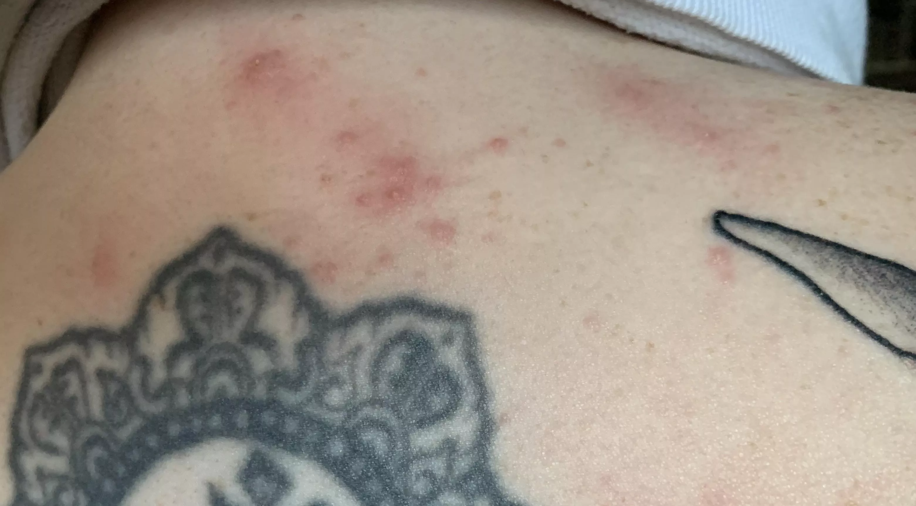 Allergic reaction to saniderm after getting tattooed â€¦. and my partner refuses to pop the whiteheads for me