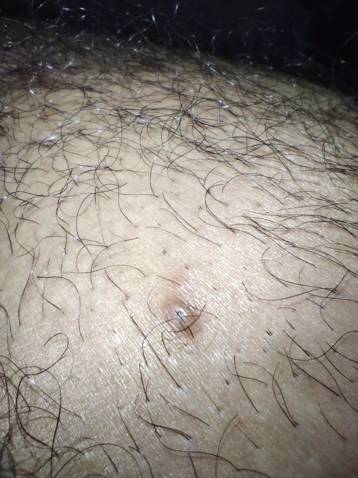 Another one_ Ingrown hair