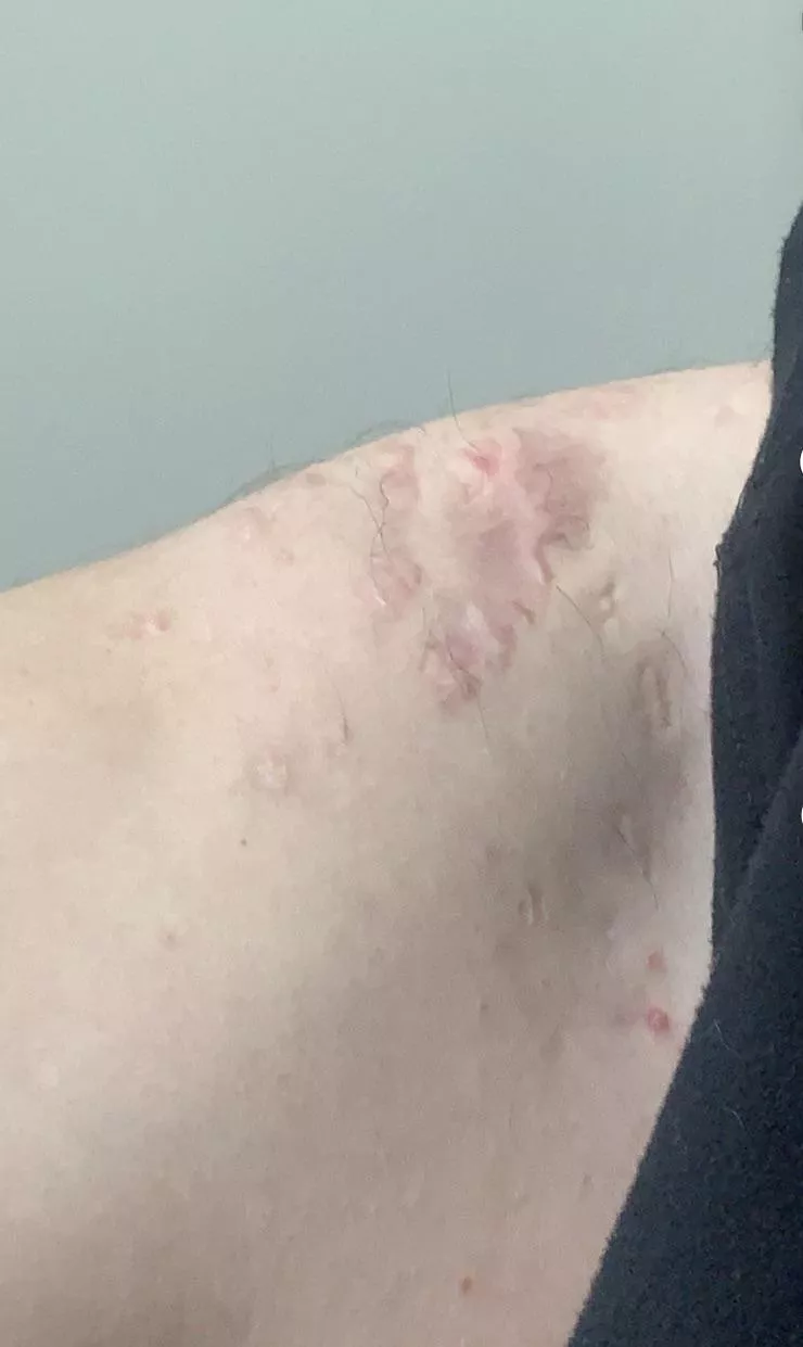 Anyone know how to get rid of some cystic acne scars, and cysts. I got them worse on my back