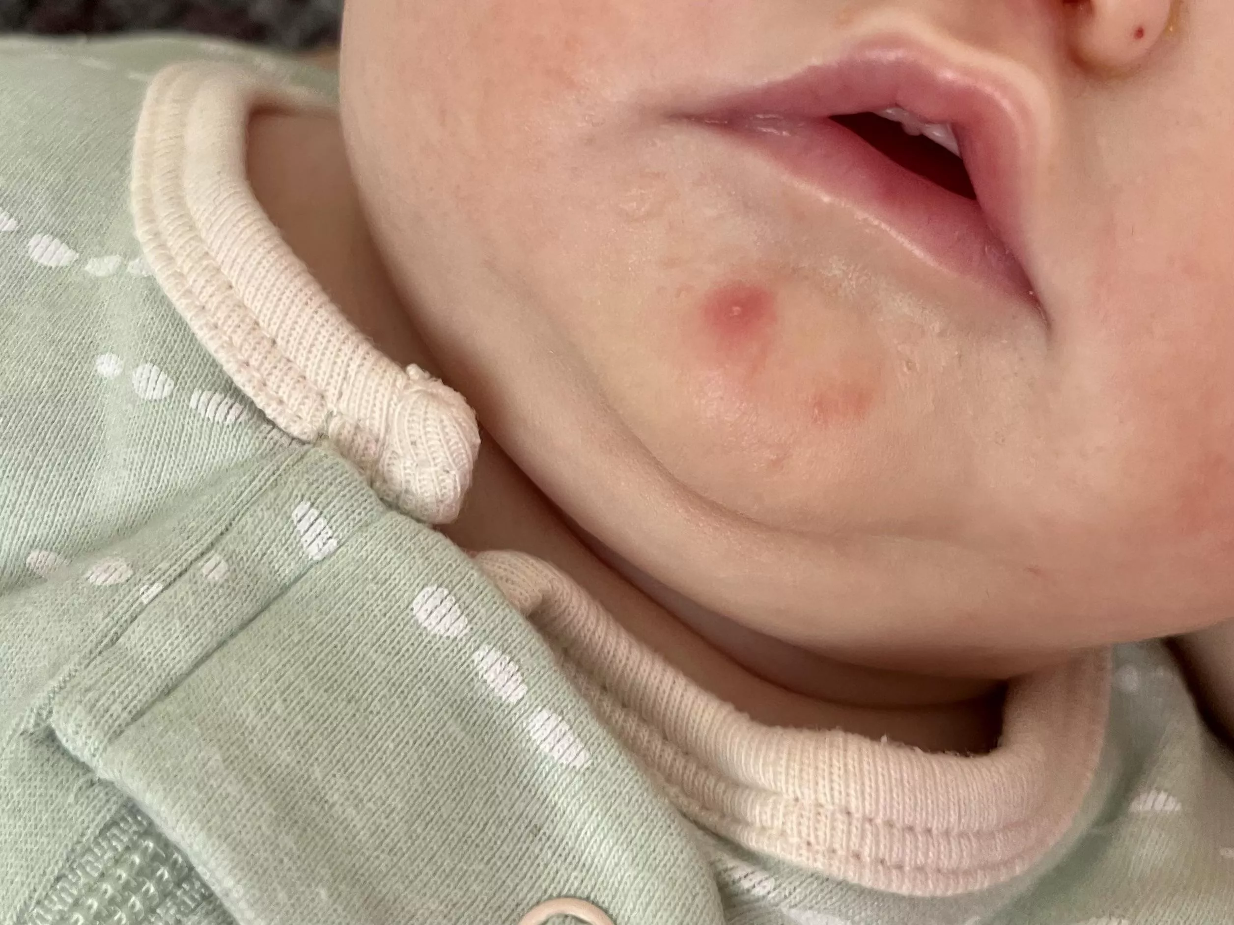 Baby acne: Forbidden pop