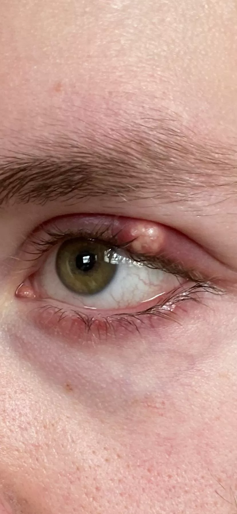 Biggest stye Iâ€™ve ever had Iâ€™m trying to fight the urge to drain it myself