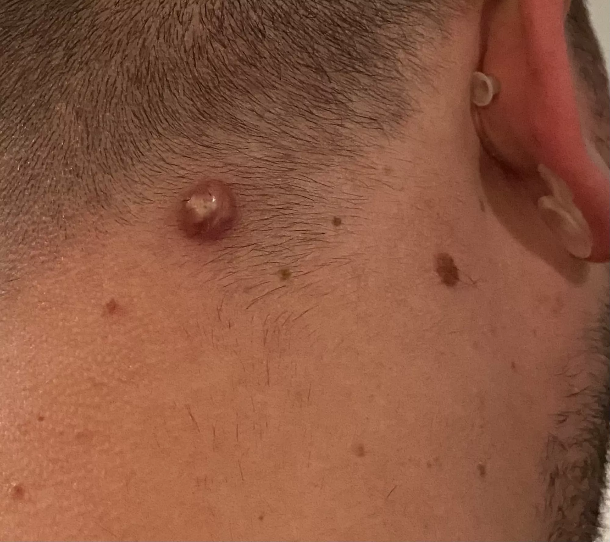 Biopsied Cyst Came Back With A Vengeance