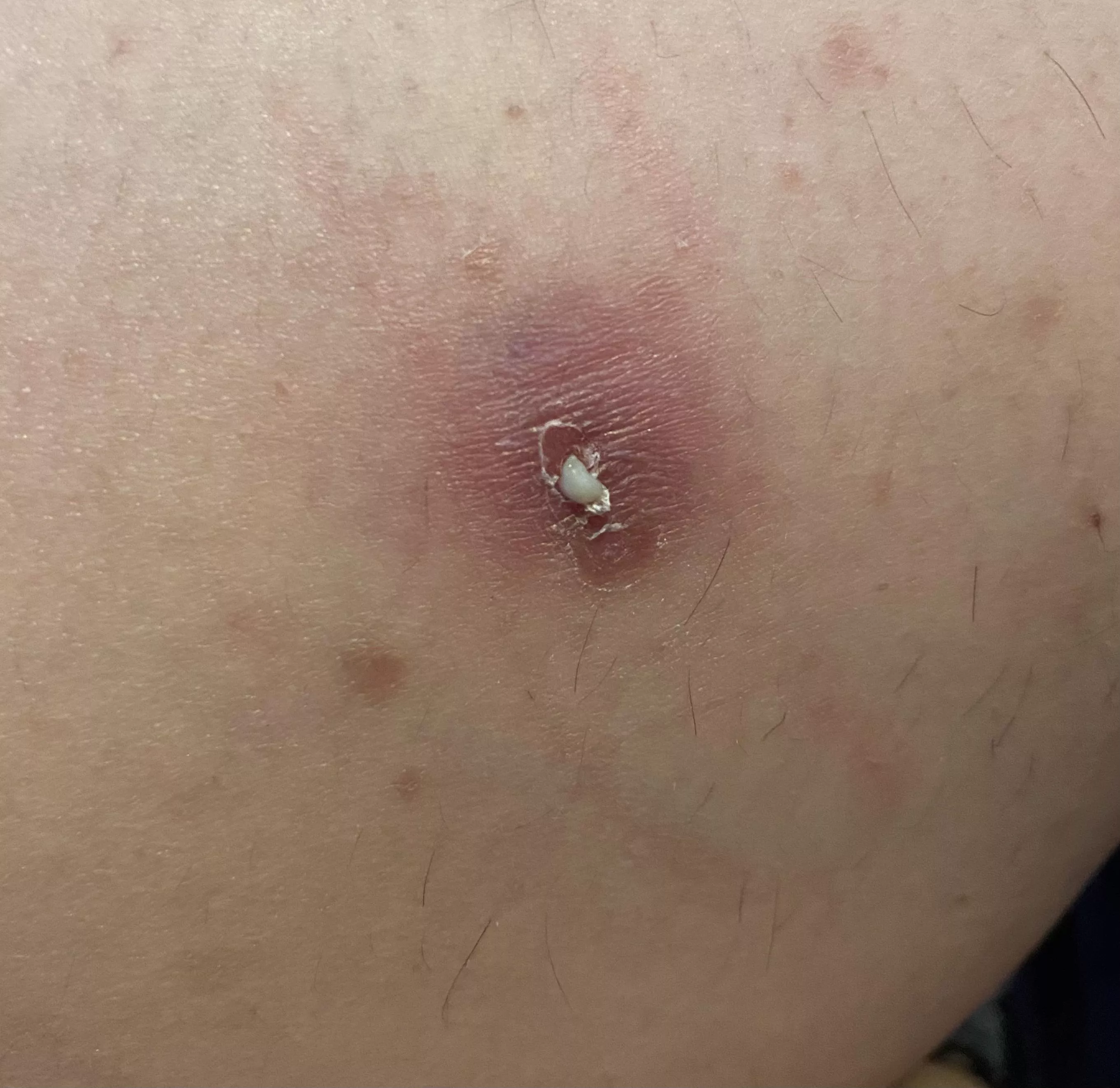 Boyfriend just got this baby off of my leg.