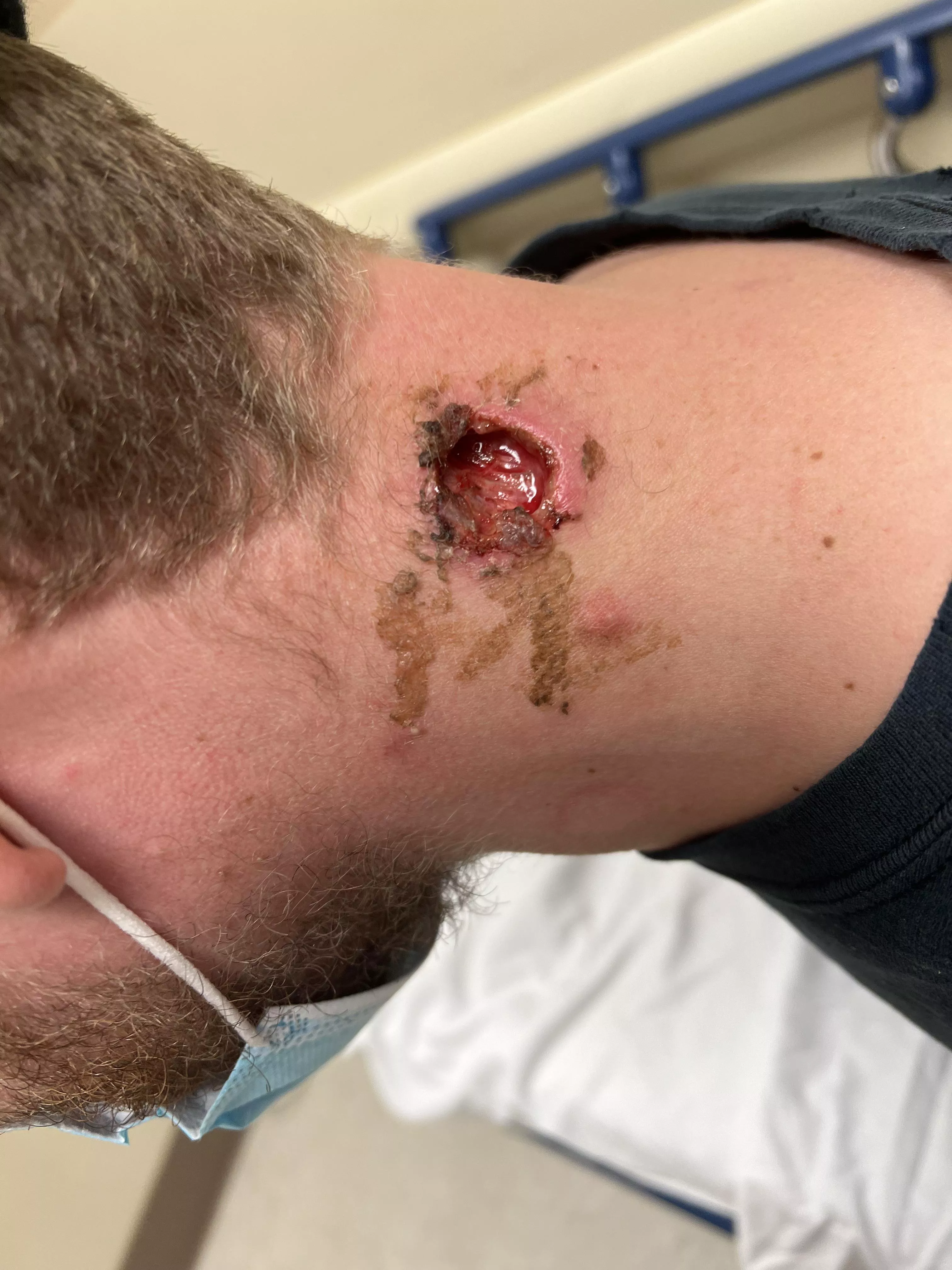 Brothers neck cyst was removed and the glue holding it together busted open. Gnarly.