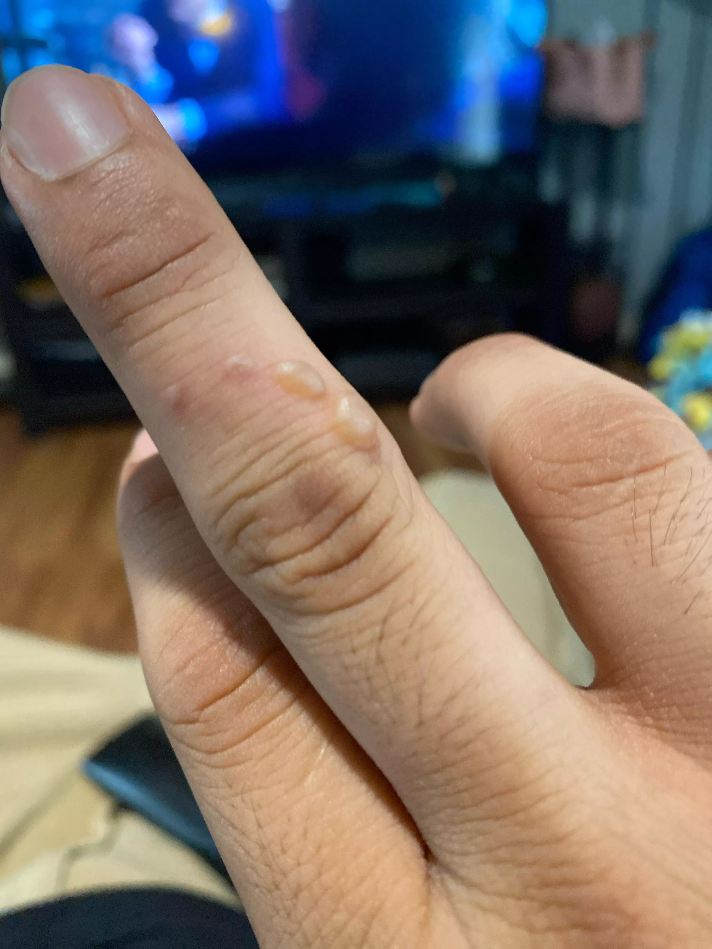 Burned myself with melting plastic