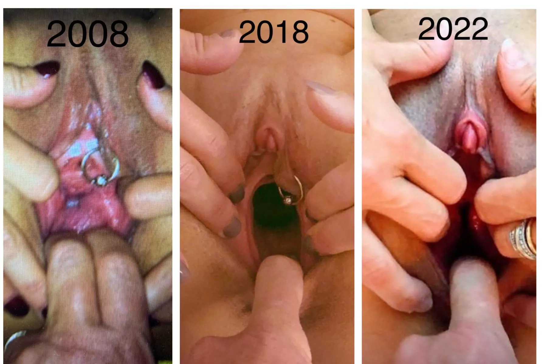 Clit growth