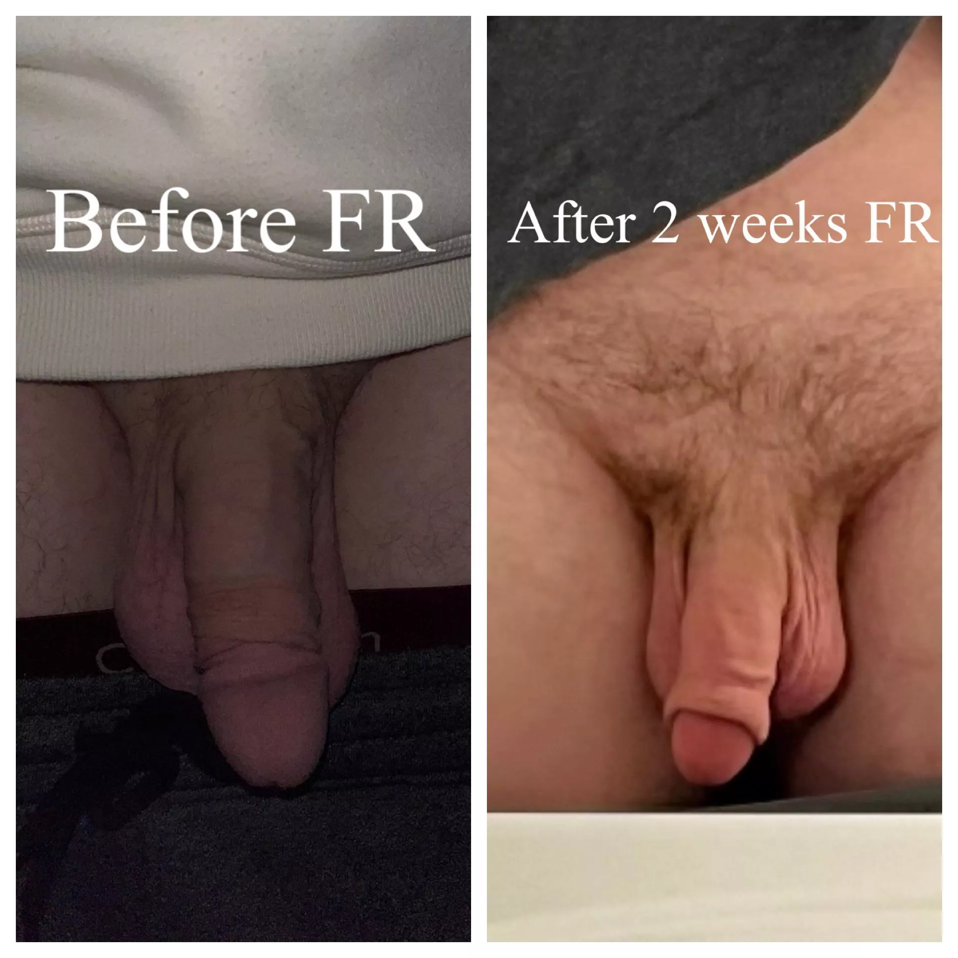 Comparing myself a few weeks after foreskin restoration! What do you think?