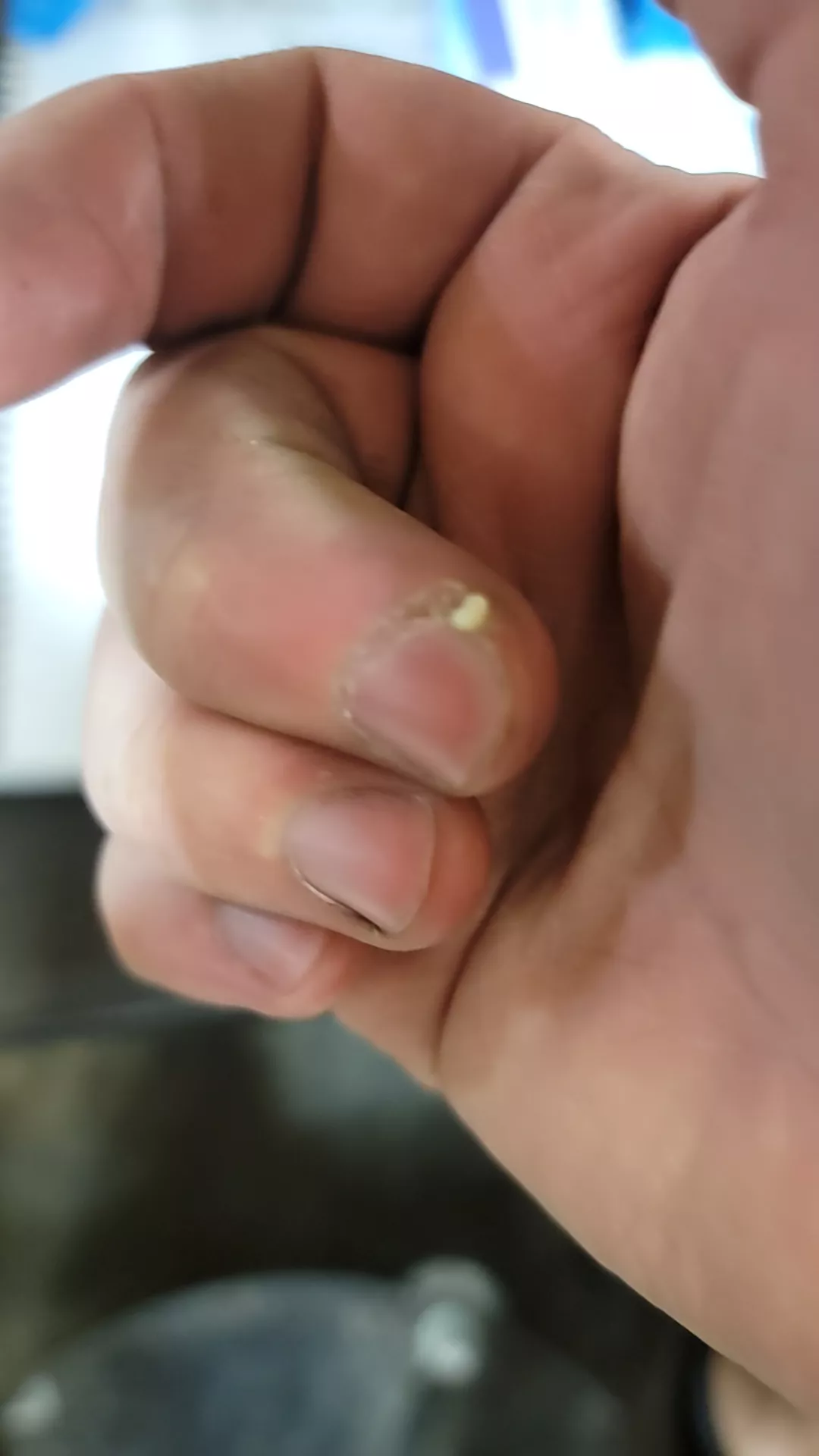 Cut off a hangnail and got this lovely little pop a week later