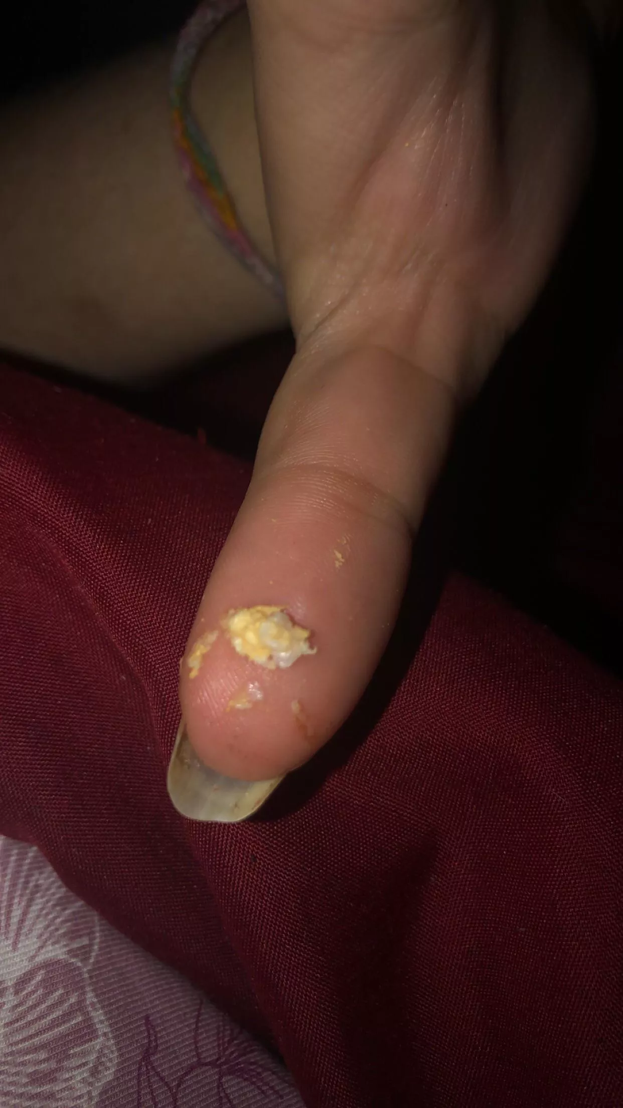 Cyst? gunk. had a small bump on the hood of my clitoris. didnâ€™t know it was a cyst until it was hurting this morning. sadly no video, but some gunk!