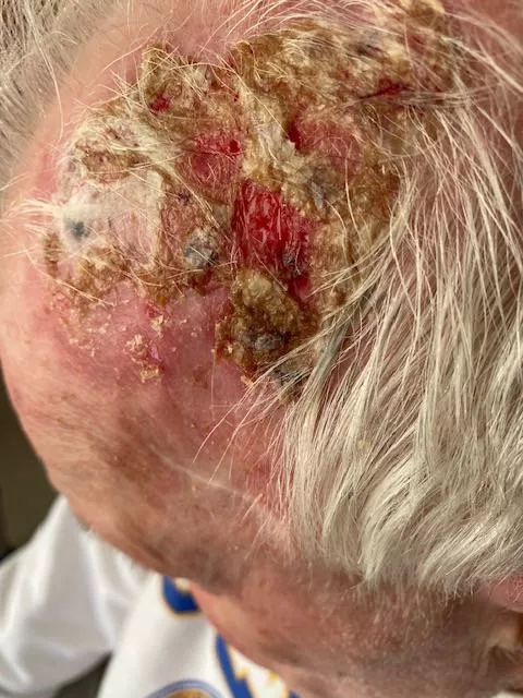 Dad had to apply some cream to burn off pre-cancerous cells and had a major reaction.