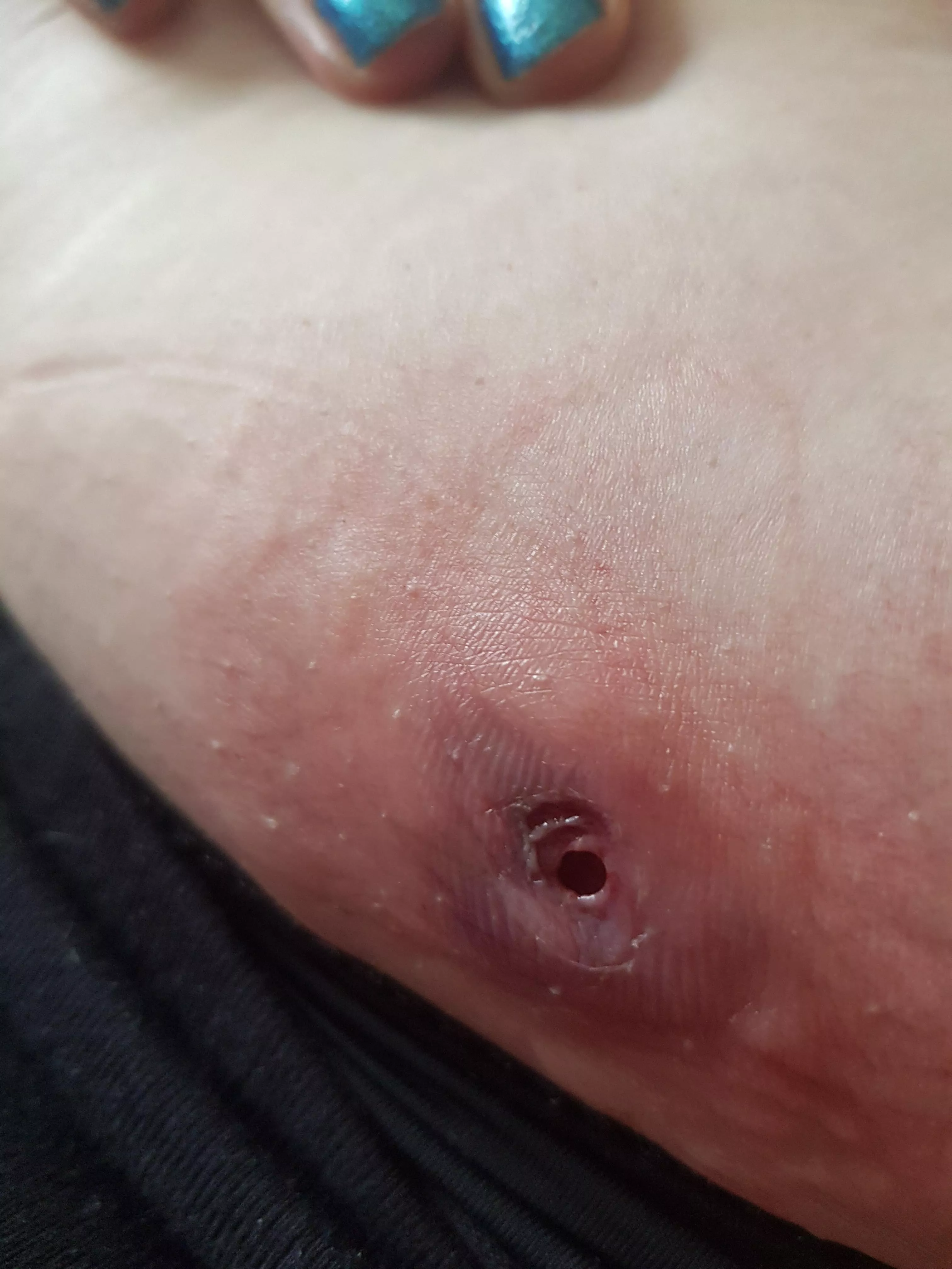 Enjoy my hole! doctor visit tomorrow. [oc]