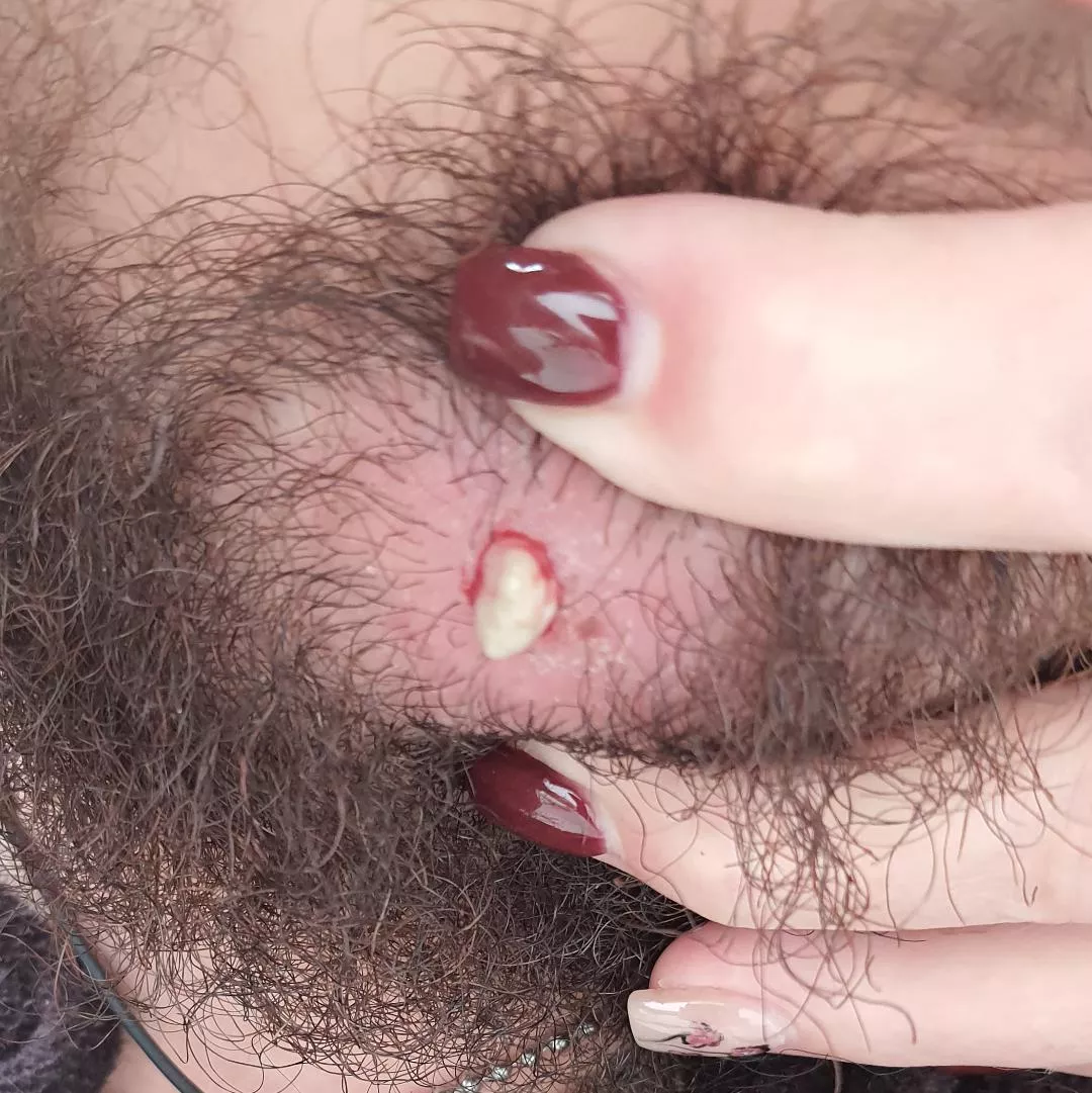 First time posting! Left over of a ingrown hair pop.