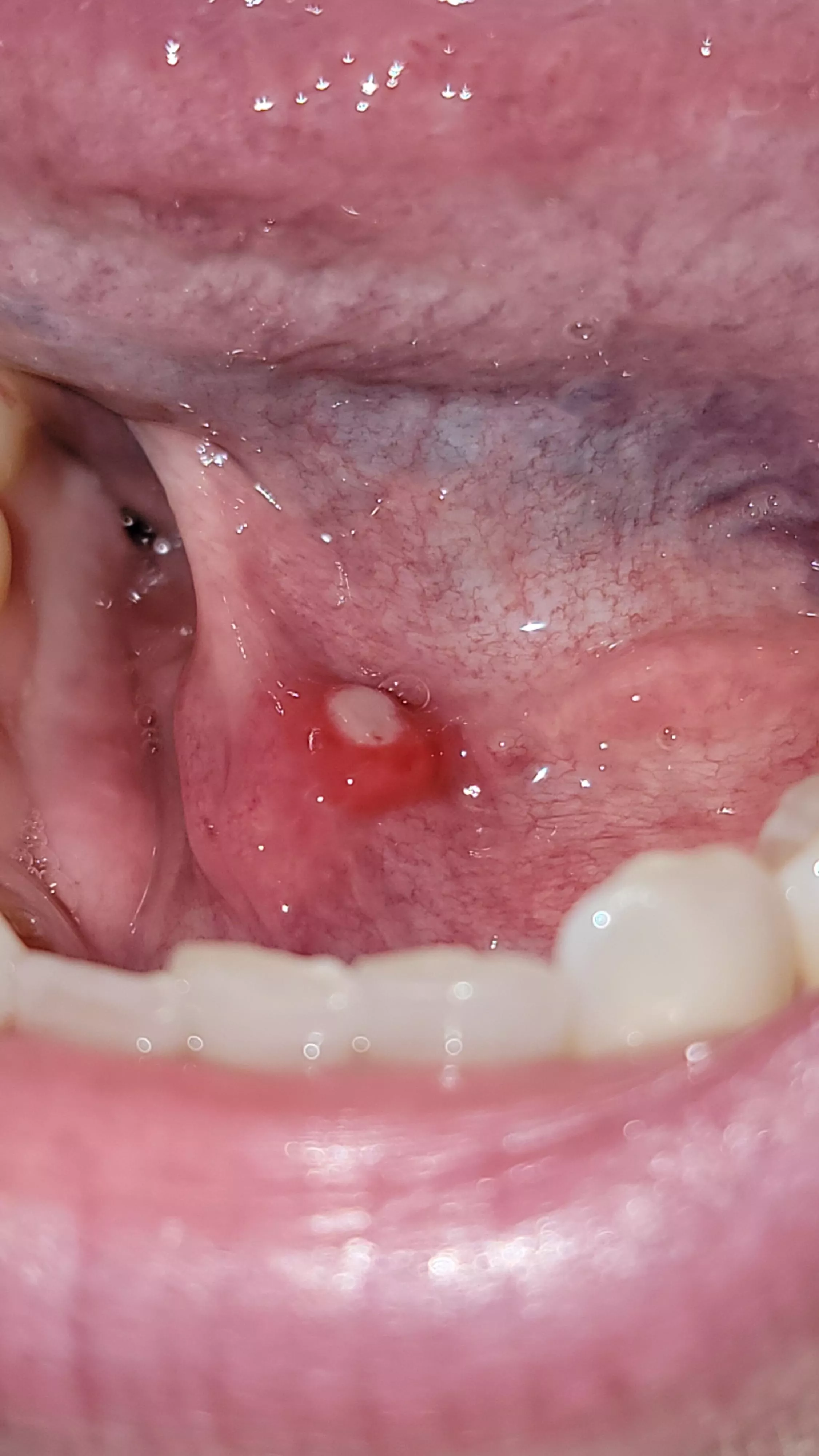 forbidden covid pop under tongue