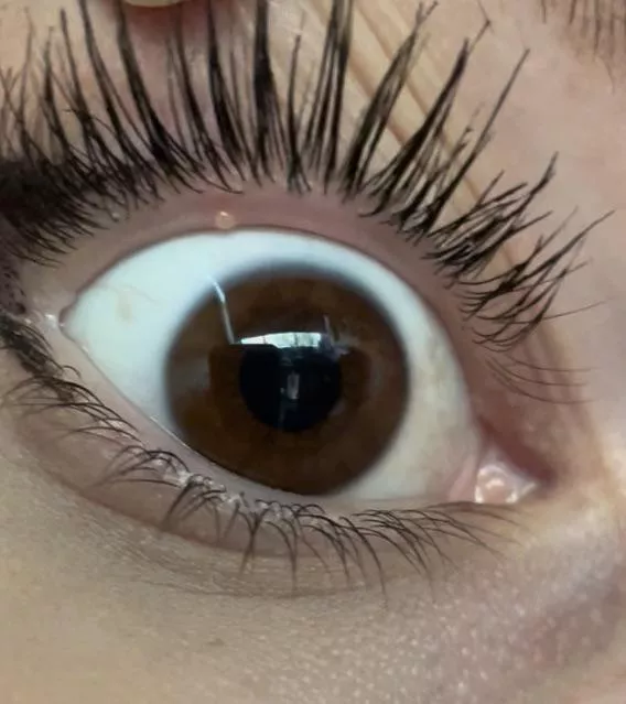 forbidden eye pop on inner eyelid