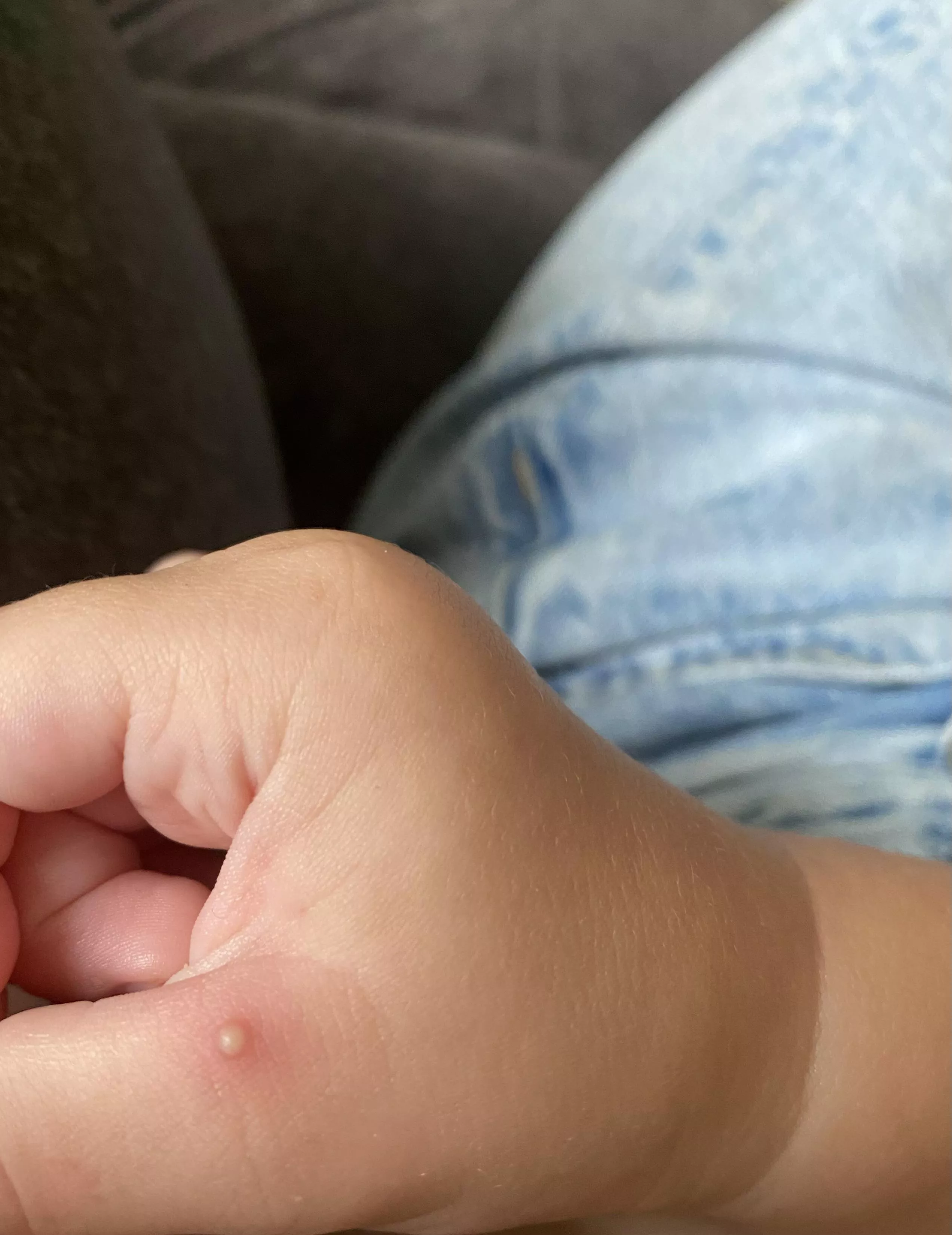 forbidden fire ant pop on my toddlers thumb 🥲