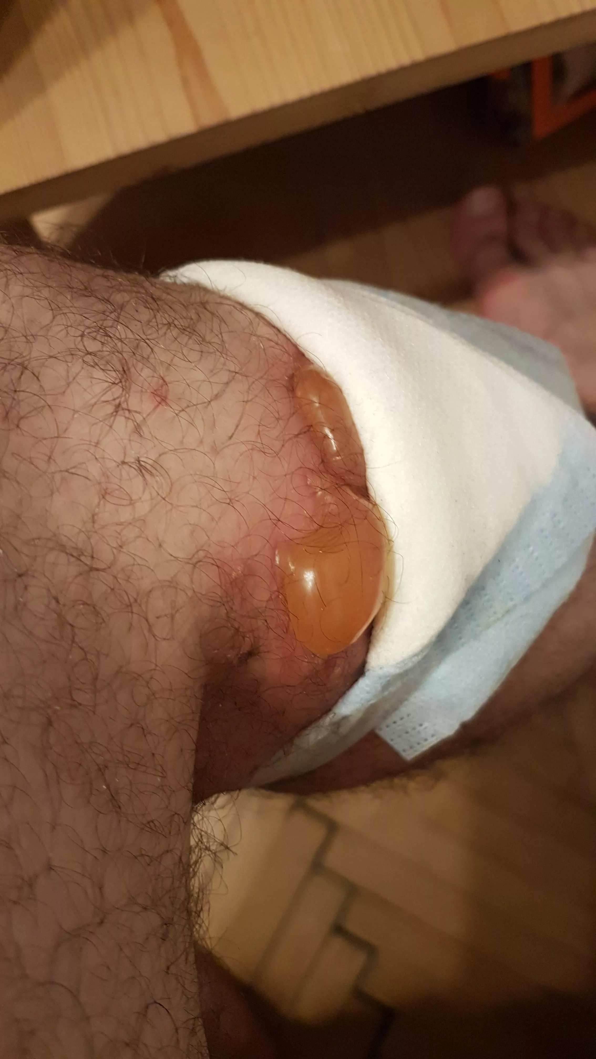 Forbidden pop - looks like I came in contact with giant hogweed while clearing the garden (wound dressing to shade from uv and catch fluids when it pops as a learning from the other leg)