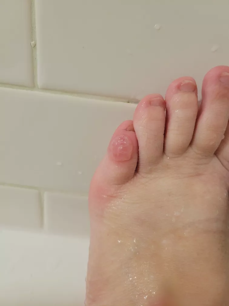 forbidden pop, my other pinky toe matches.