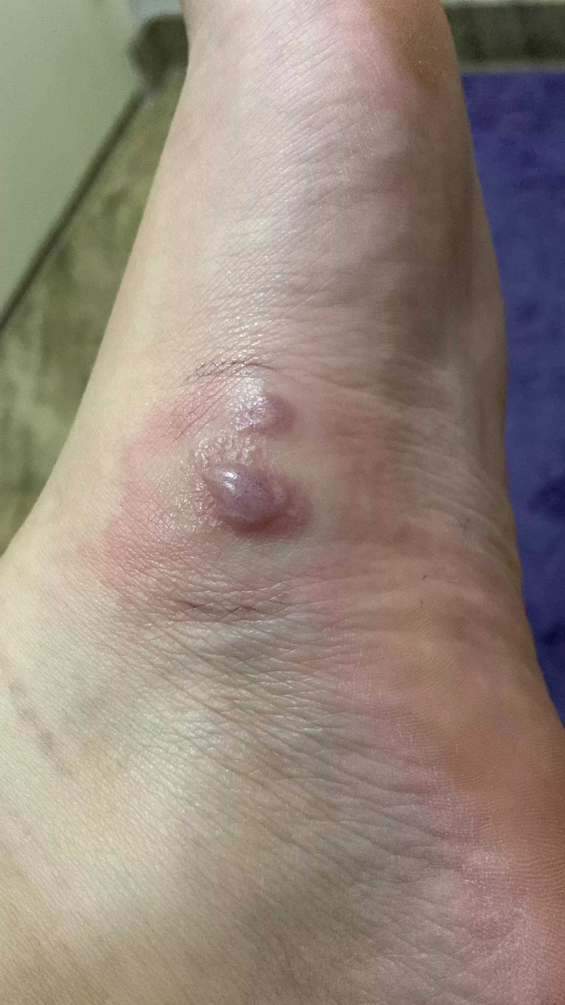 Forbidden pop on my foot. Already went to the doc. More on the comments