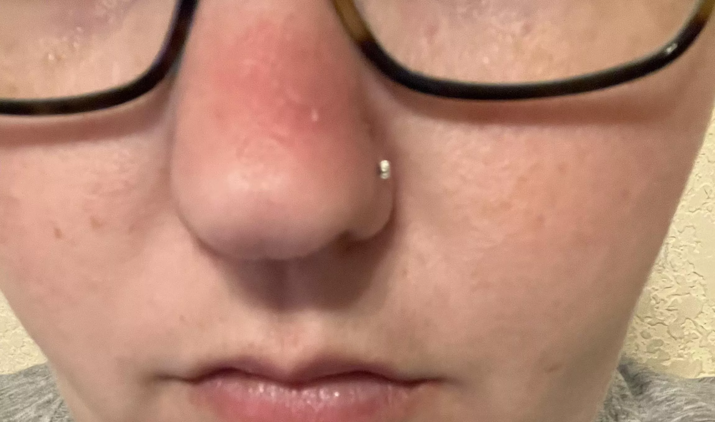 Forbidden pop. Red, swollen, and extremely painful spot on my nose. I have one of the patches on it so hopefully it helps by in the morning because the pain is ridiculous.