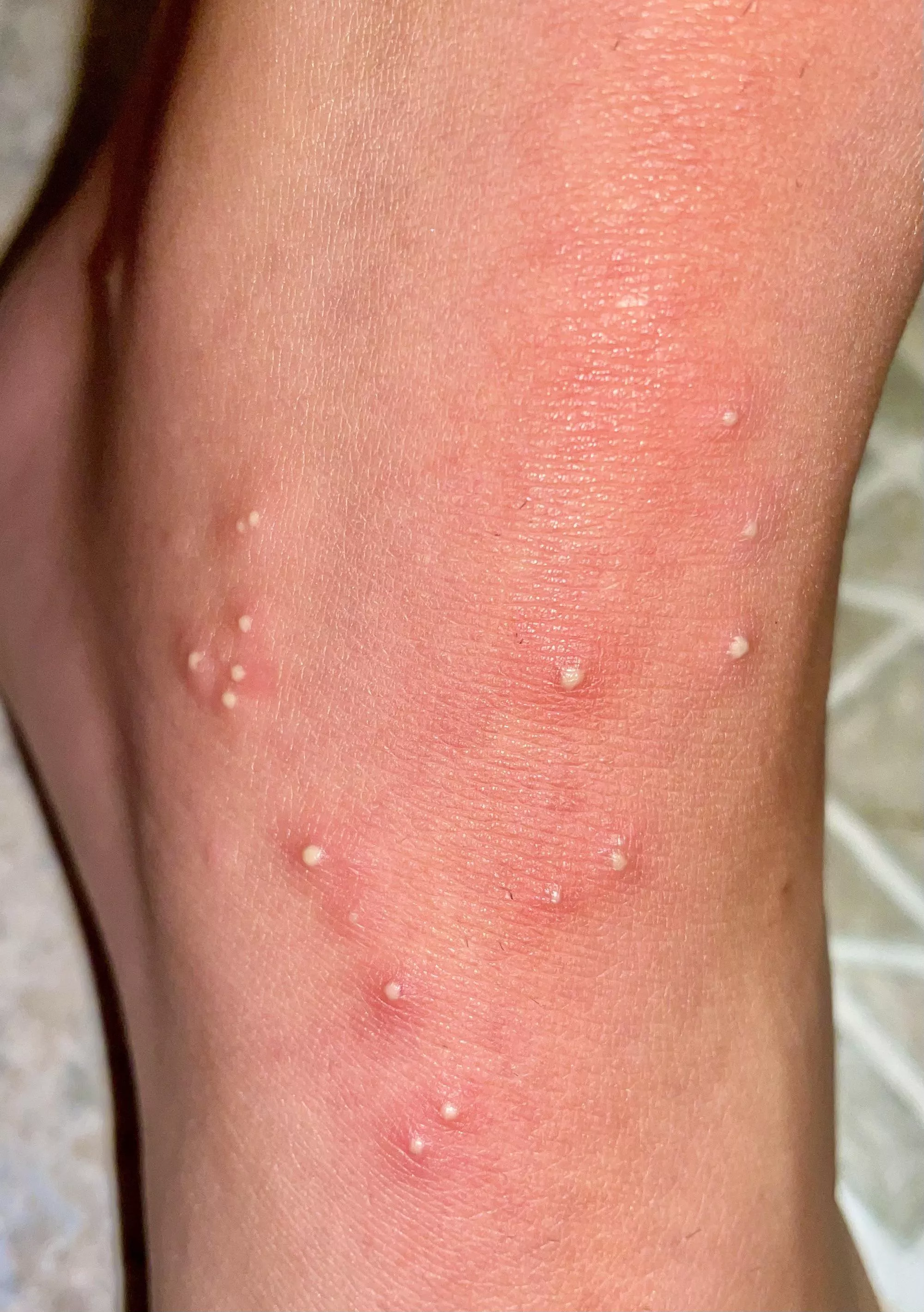 Forbidden pops. Fire ants: 19 - Ankle: 0