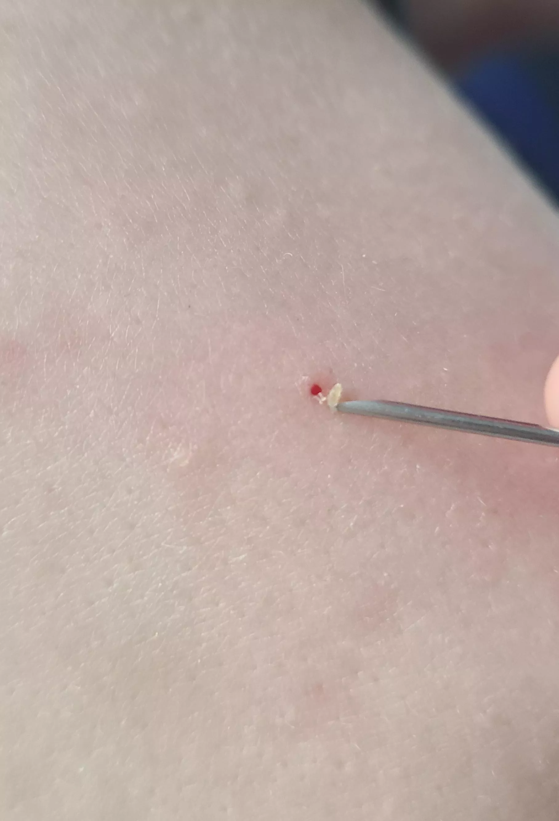 Giant hole left in my bfs shoulder from this blackhead