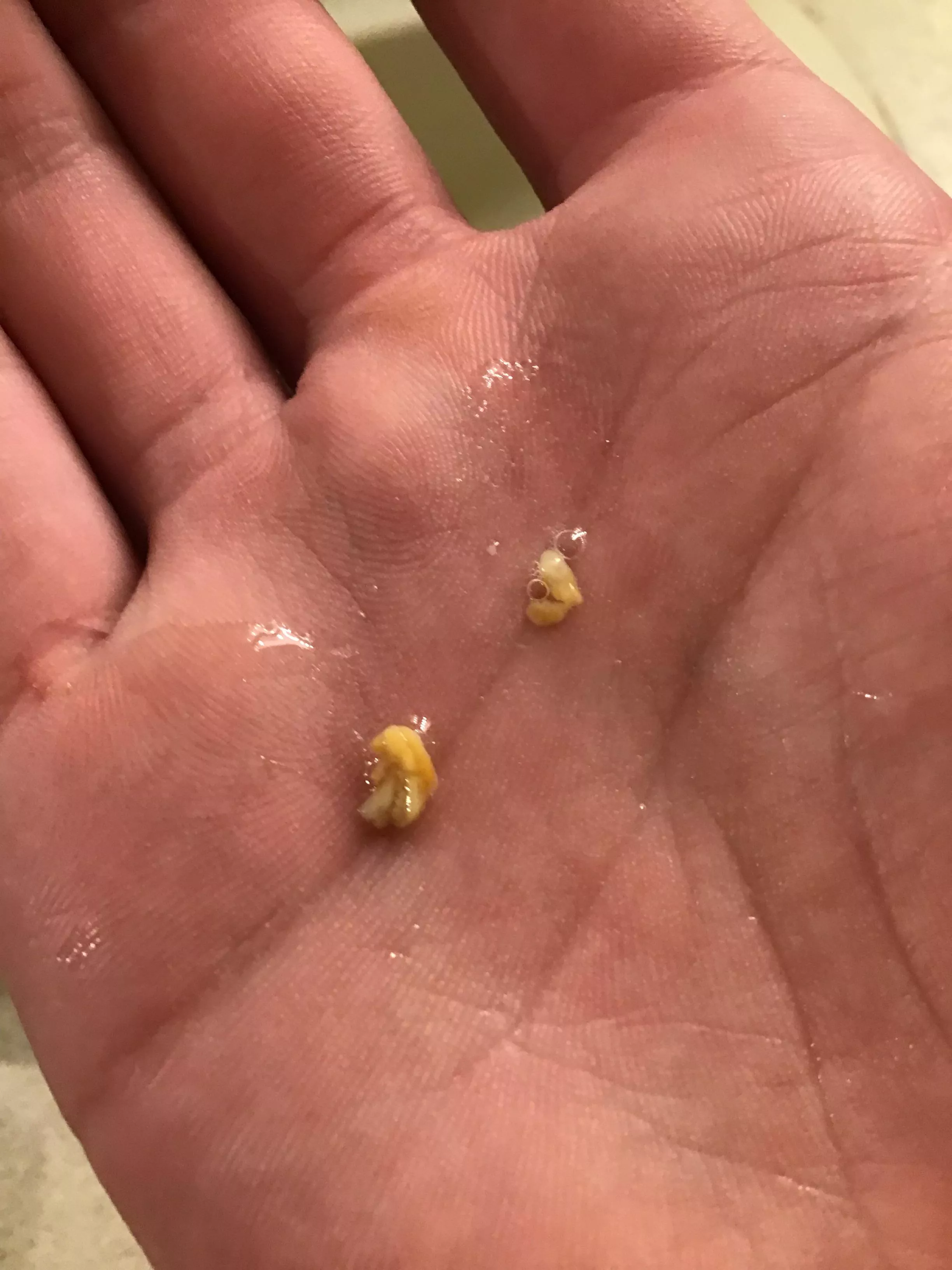 Had some of what I presume to be tonsil stones that came out of my throat. I could feel them for a few days like something stuck there