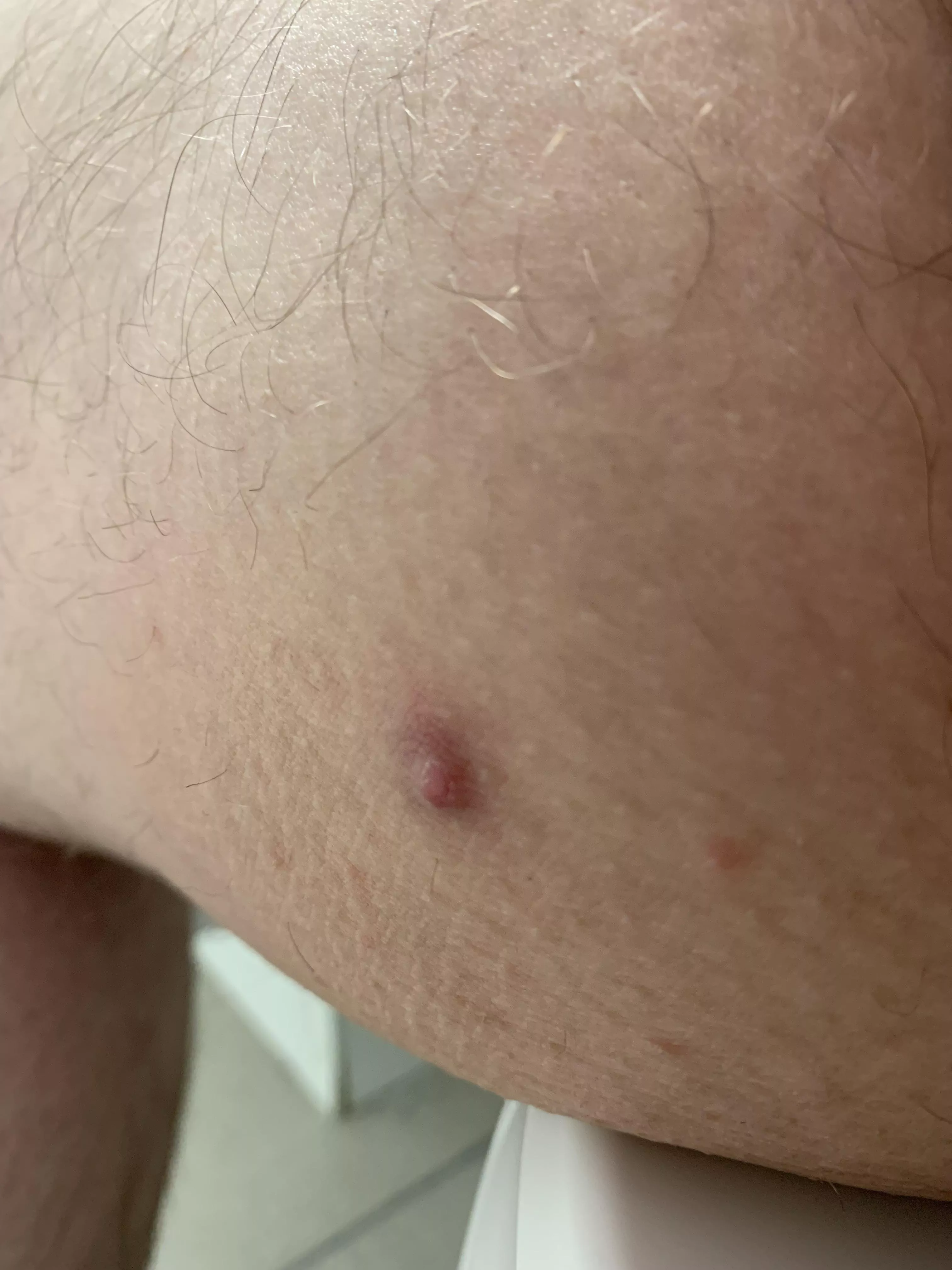 had this on my inner thigh for about two weeks now, it’s not popping and is a little sore