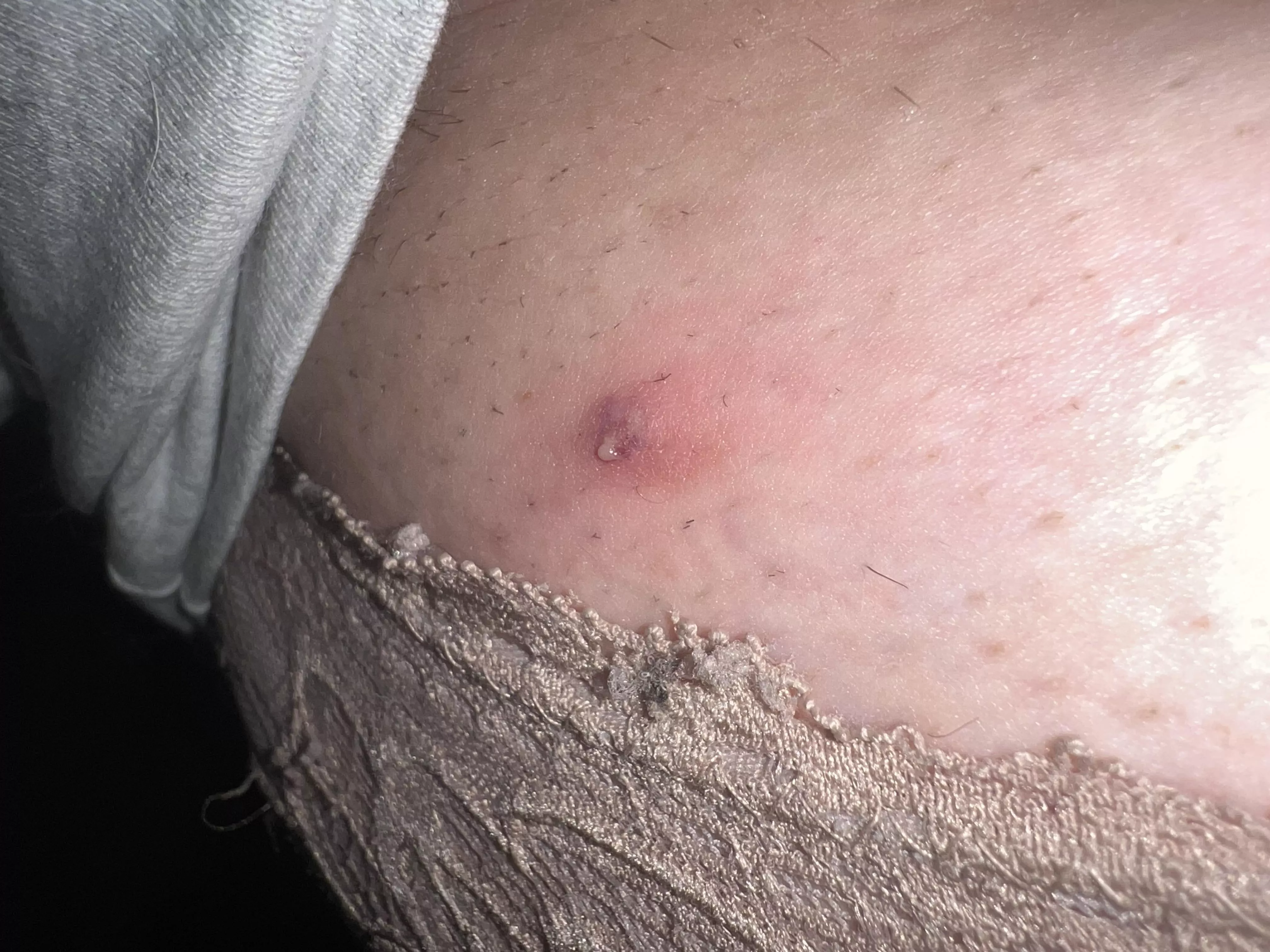 had this weird thing under my arm. popped it earlier. itâ€™s been hurting all day, checked it and this is what it looked like!! ew.