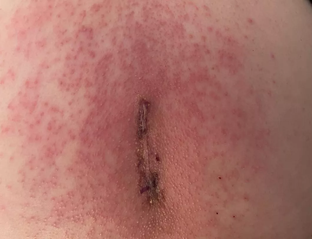 Having a very itchy reaction to surgery