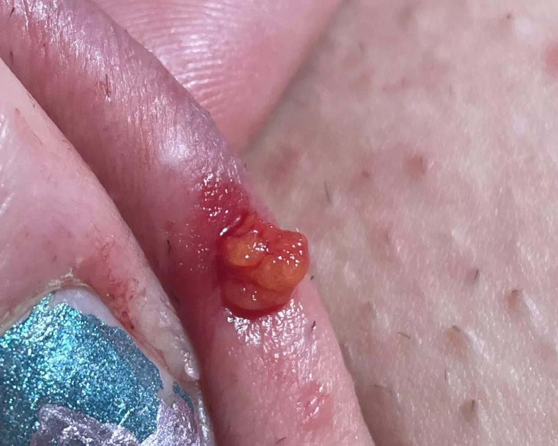 Help! What is this? After digging out an ingrown hair I started to pull this stuff outâ€¦ is it a cyst?