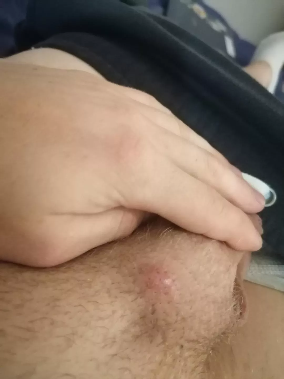 How to pop this ingrown hair?