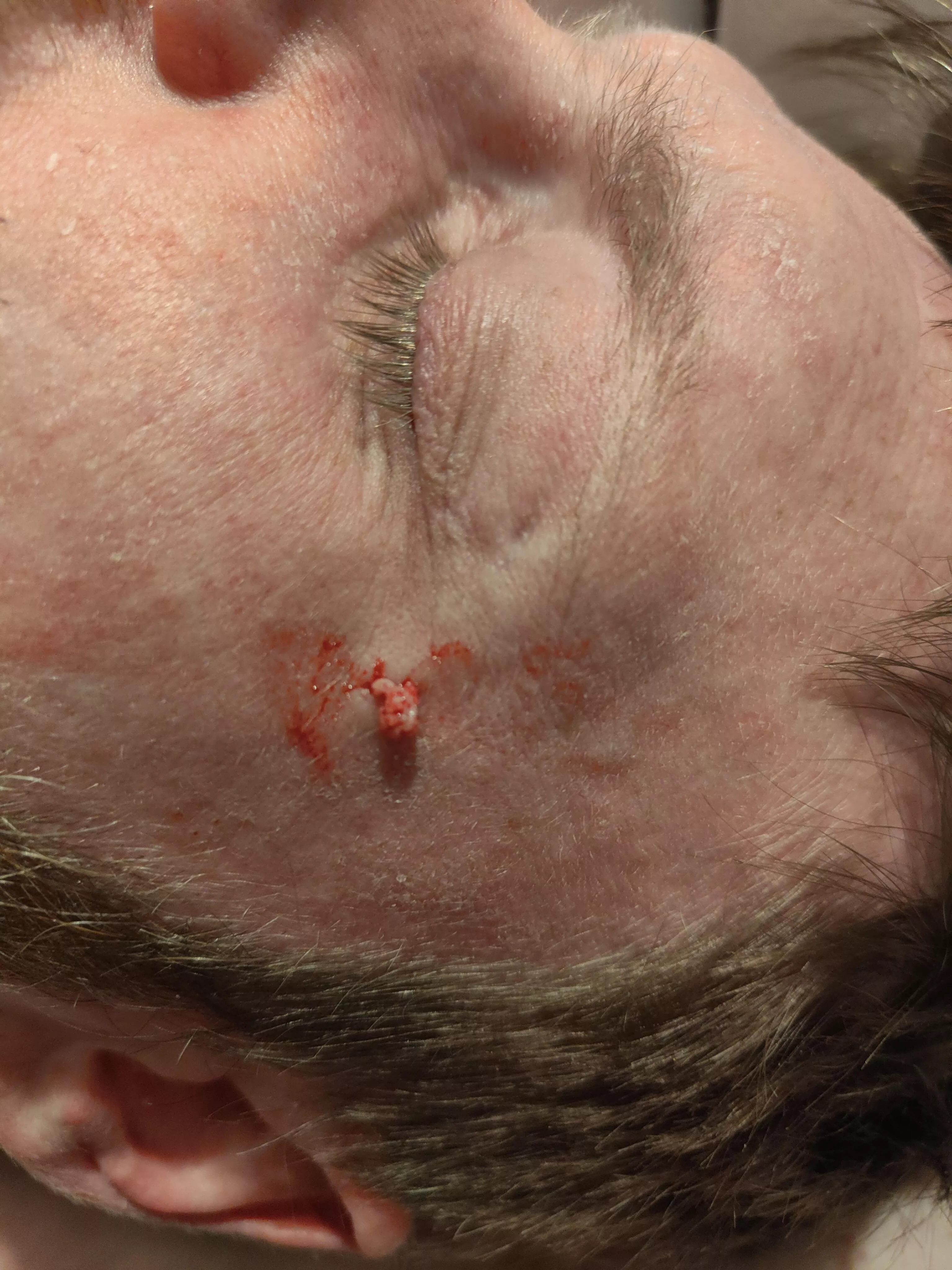 Husband has had a lump on the side of his face months and he finally let me at it with my extraction kit. This is only a tiny fraction of what came out, I wish I'd set the camera up to video!