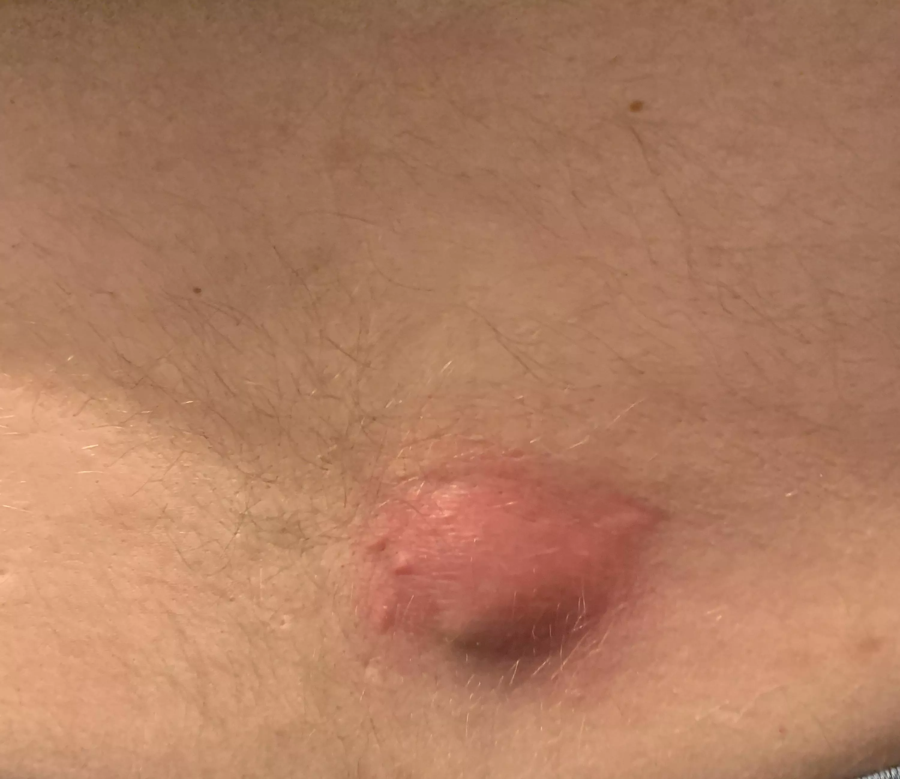 Husband’s back cyst (info in comments)