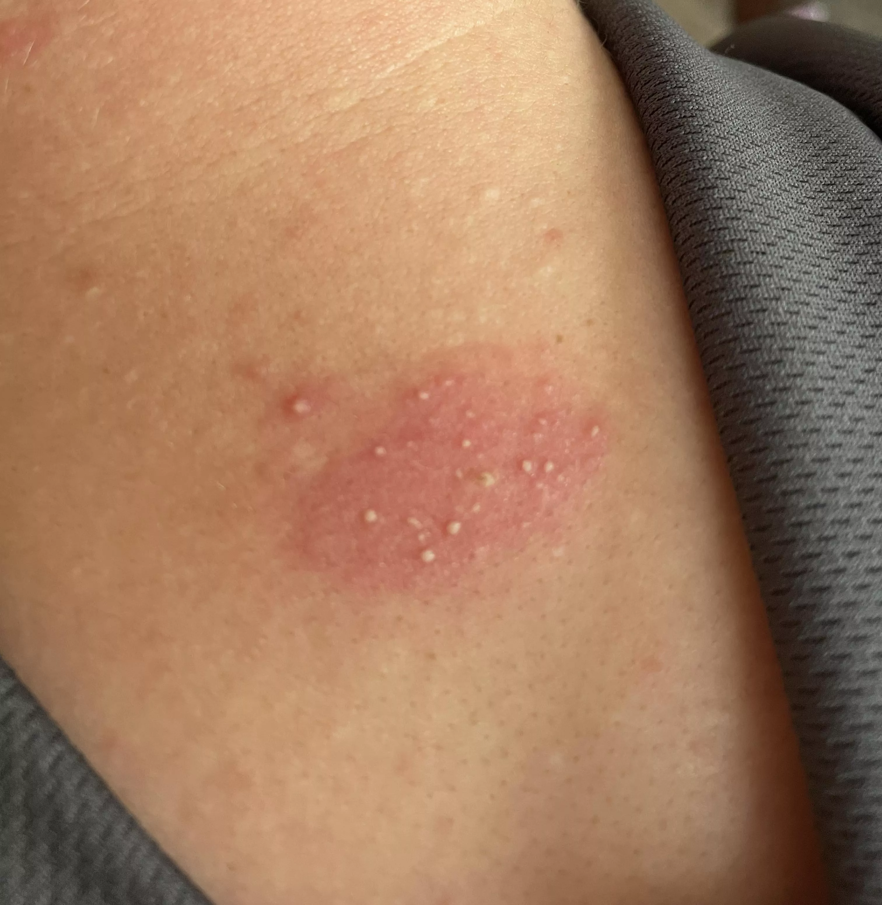 I donâ€™t know what caused this. Bug bite? Want to pop.