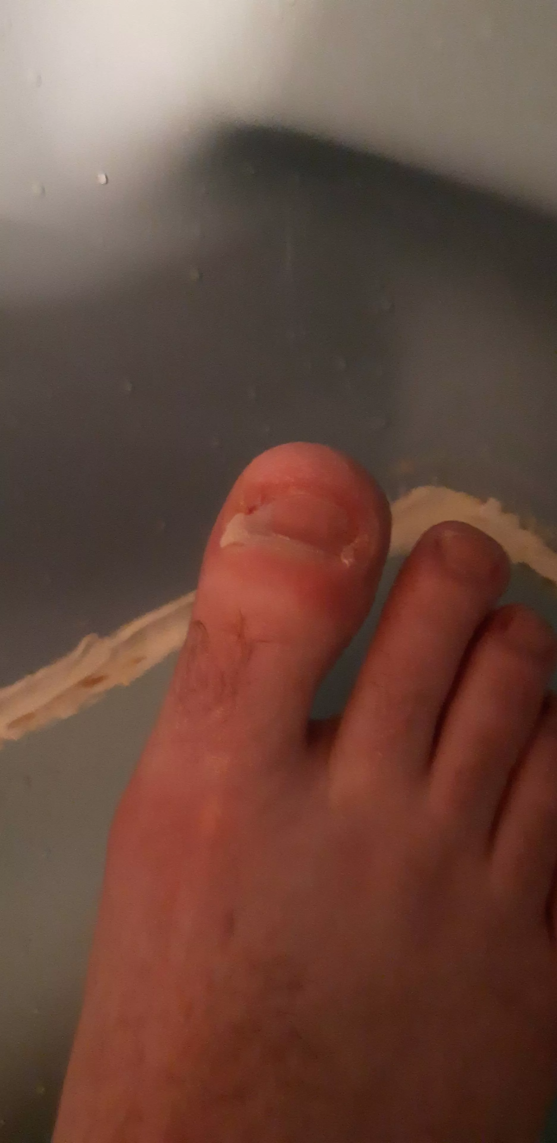 I get chronically ingrown toenails