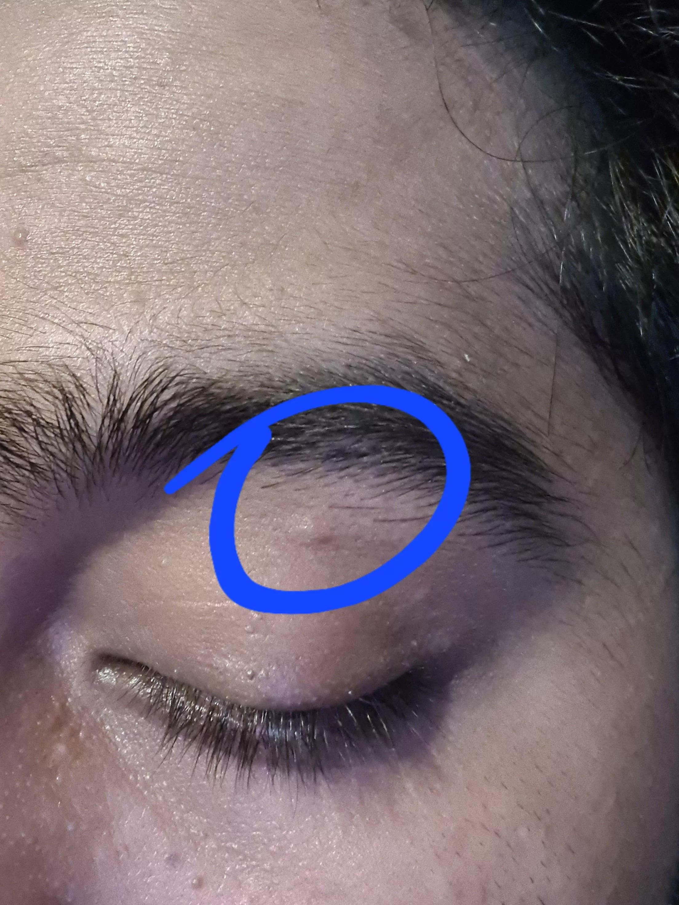 I have this bump like thing above my eye lid since yesterday. Is this normal or should I get it checked up?