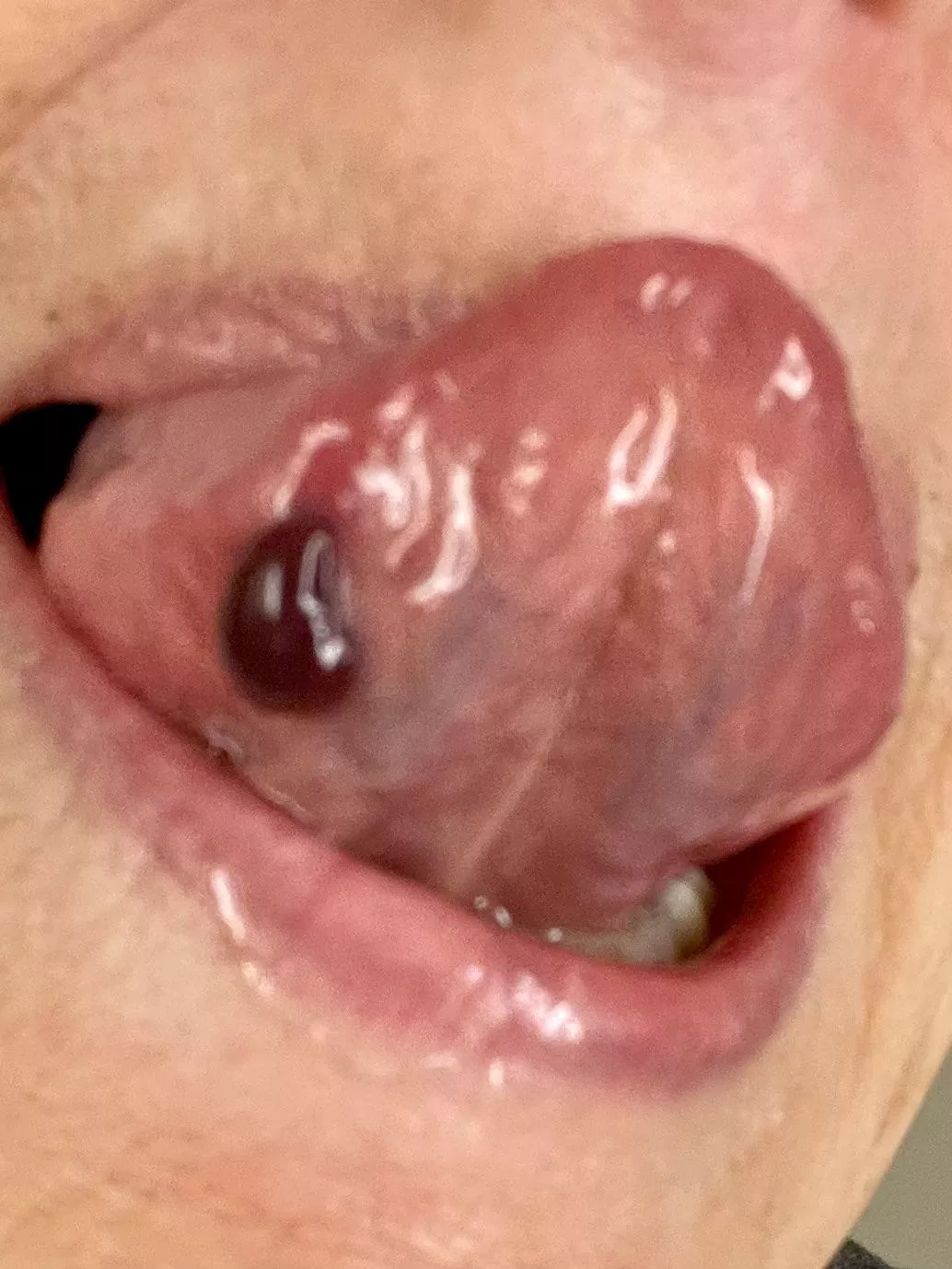 I wondered what was irritating the side of my tongue? Sorry, it was way too awkward to photograph and pop at the same time.