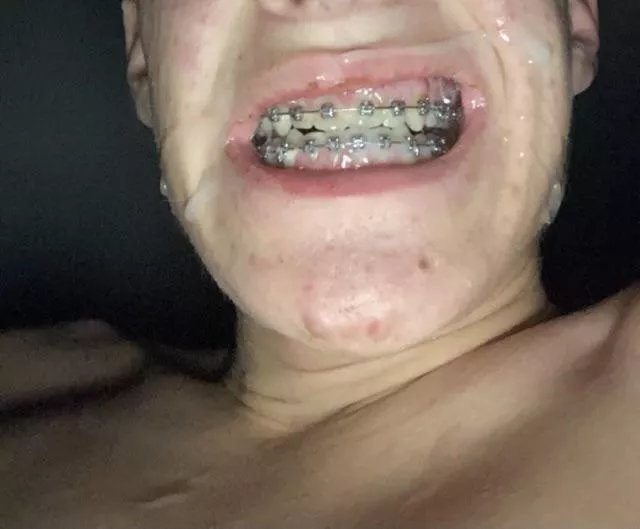 If you like Braces and cum? Upvote 😏