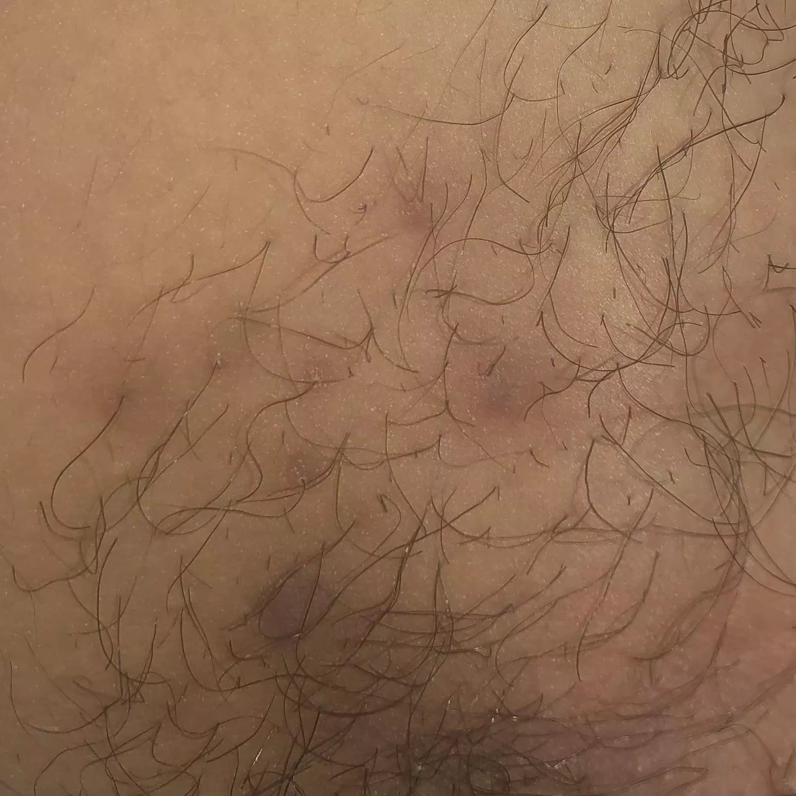 Ingrown hairs, boils, or cysts? Appeared after shaving, caused by chafing from wearing pads. Feel like pea sized hard lumps beneath skin. More info in comments