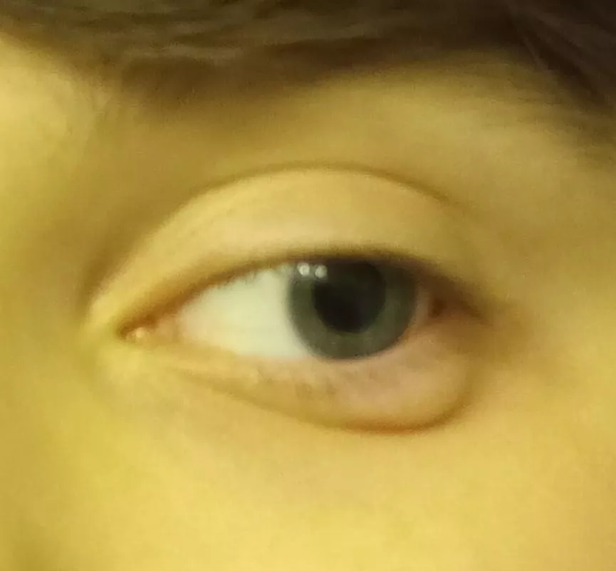 is this a stye? it appeared extremely suddenly, like within an hour or two