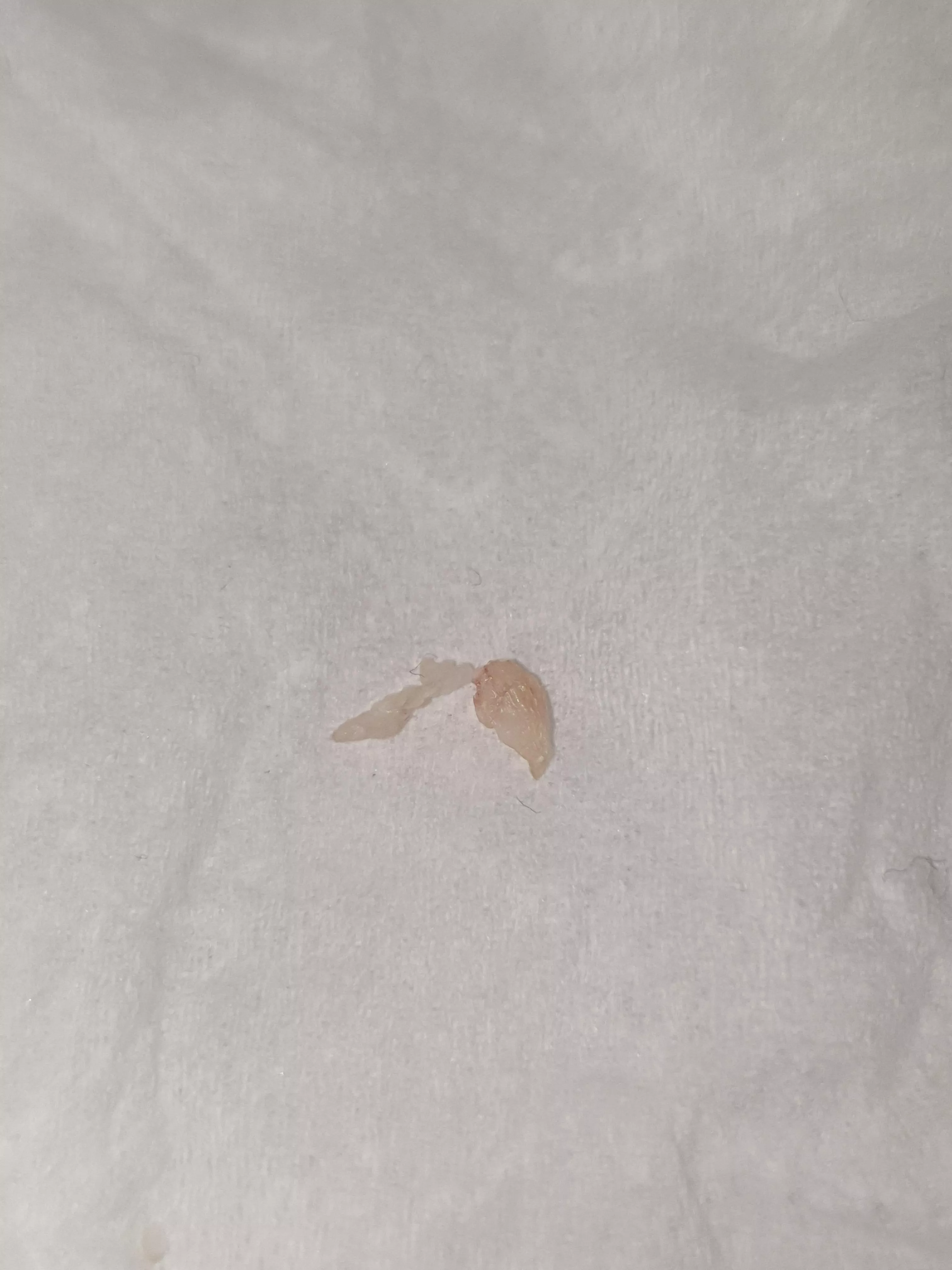 Just popped this on my chest after it botherd me for weeks now. Its quite hard tissue, what do you think it is?