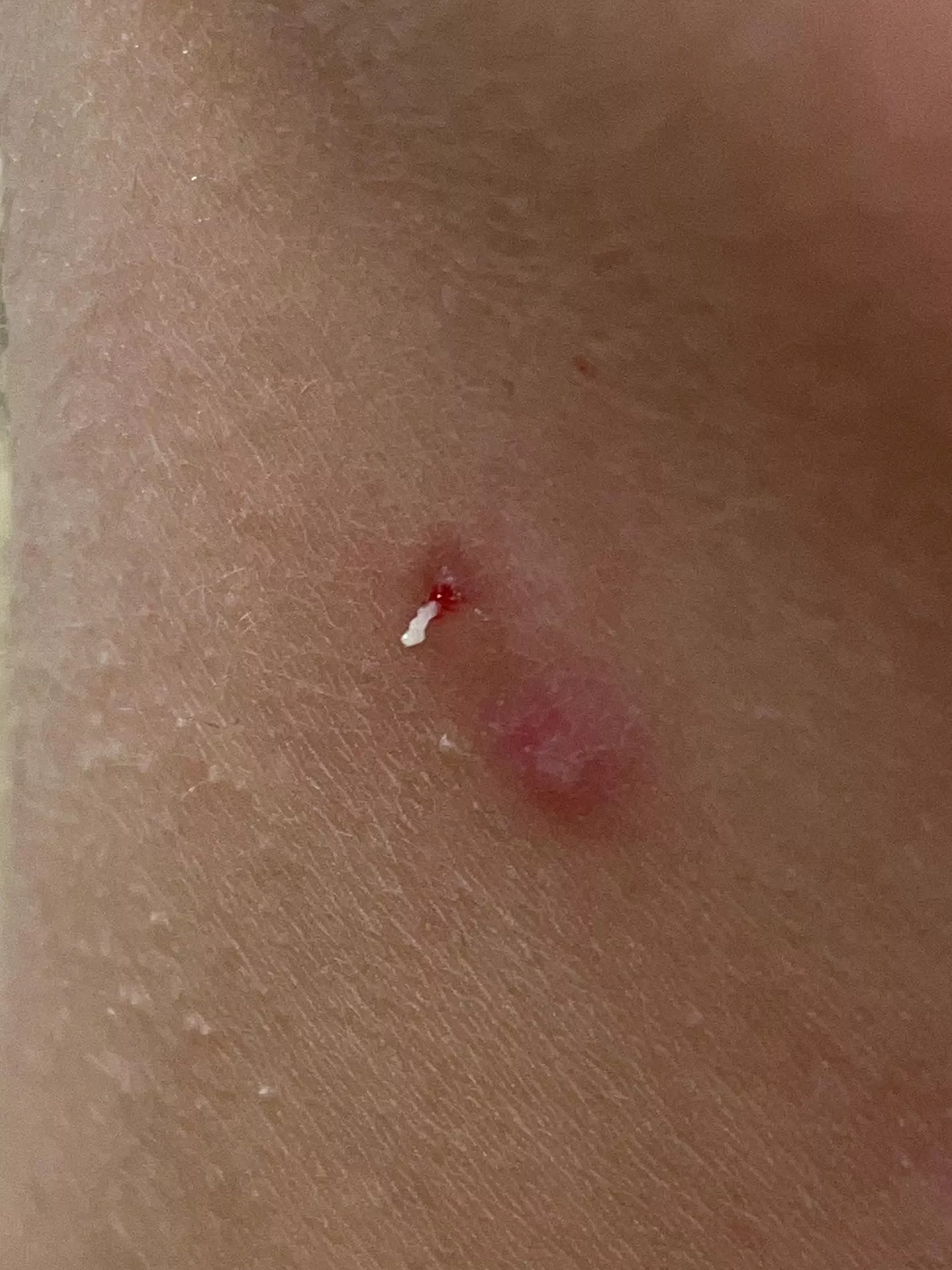 Little Pop On My Neck