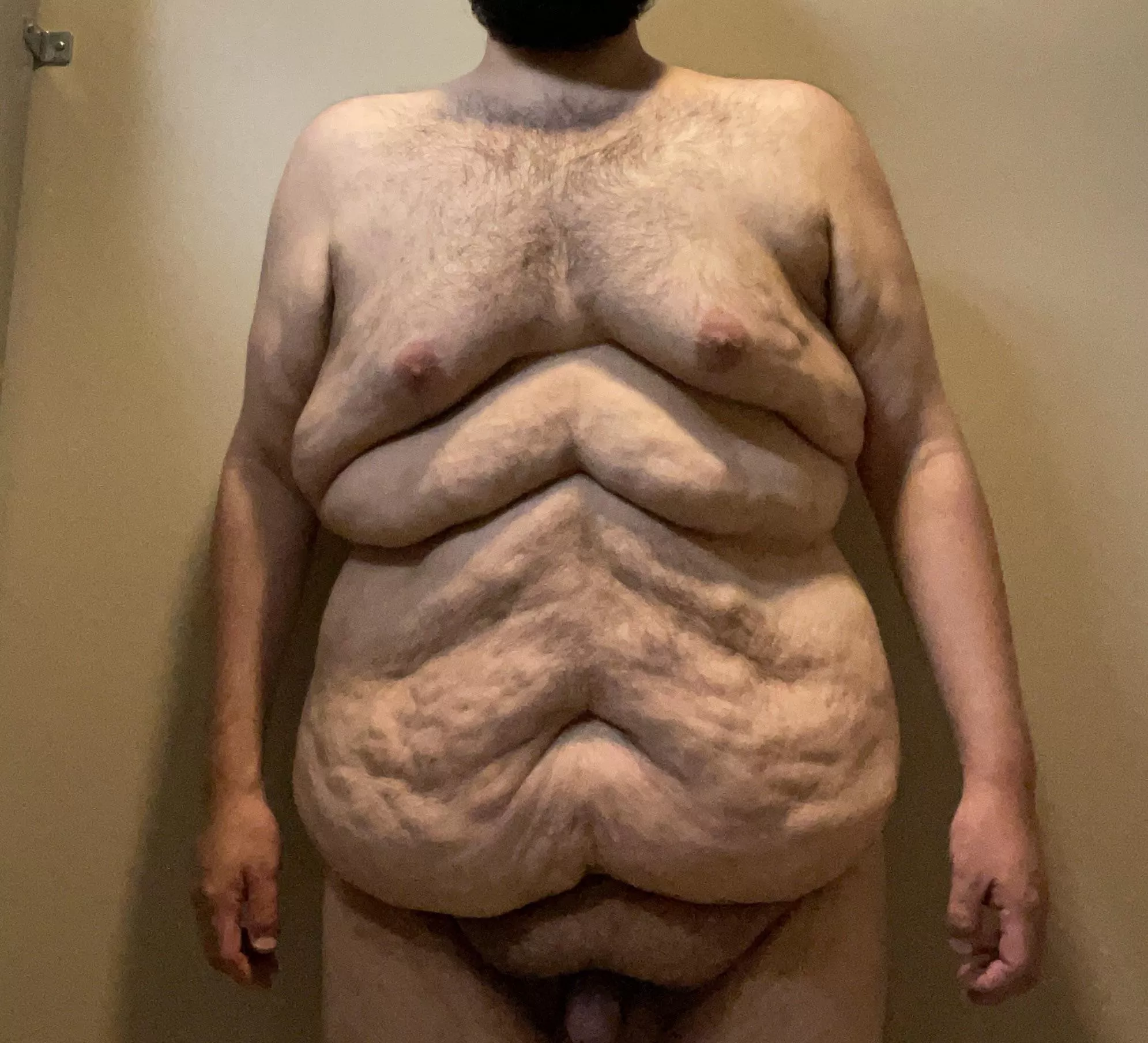 M/26/295 This is my body after losing 125 lbs. Iâ€™d choose this body over being +400 lbs any day. The fat roll between my chest and stomach was caused by stomach gripping for the last 16 years.