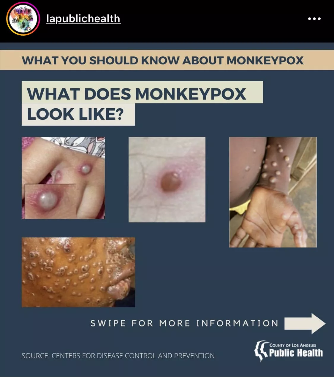 Monkey pox looks so tempting to pop!