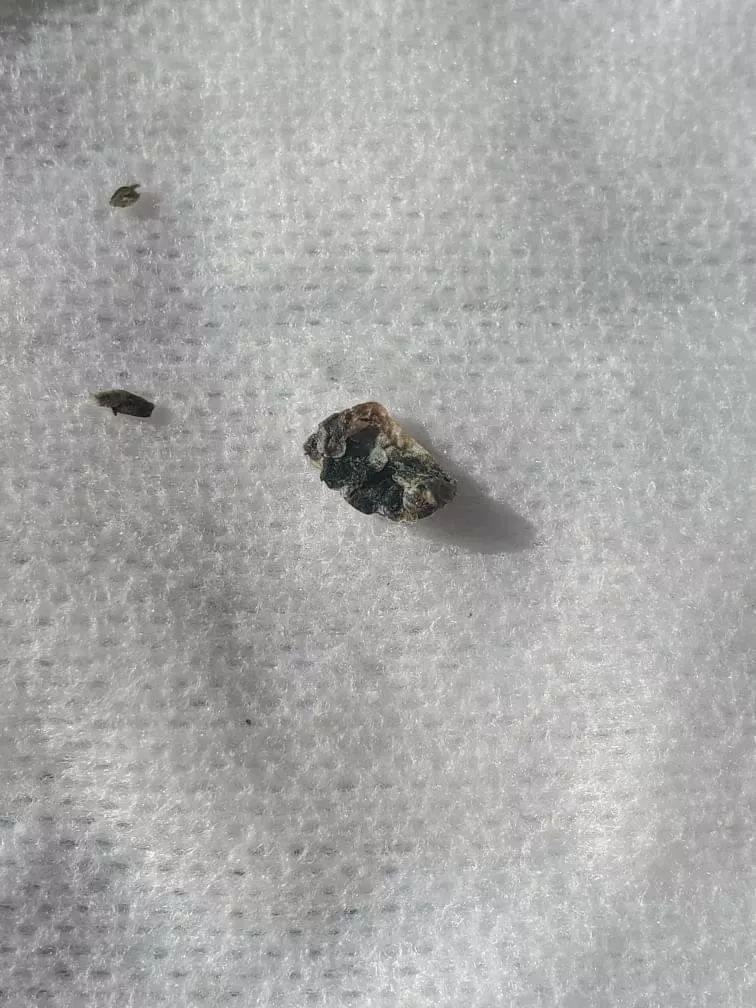 My friend's doctor found this mold in her ear. She is horrified. I am sooo curious about how this can happen.